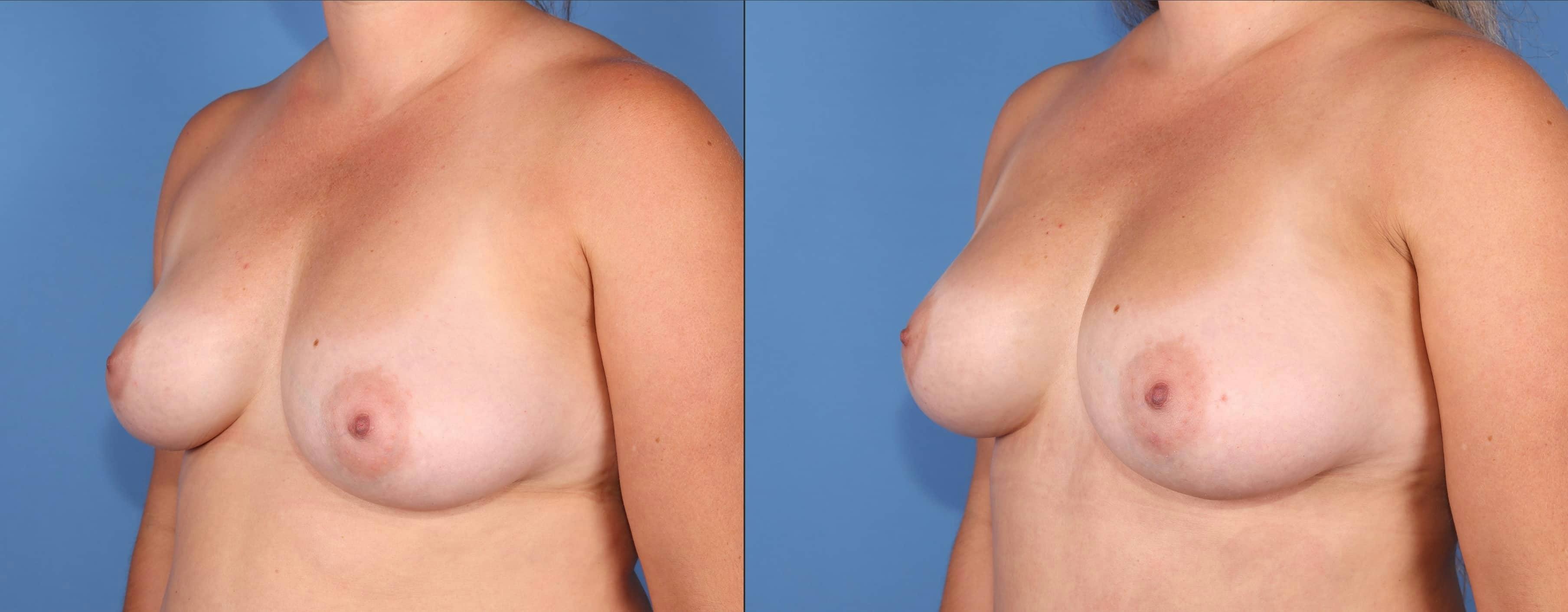 Fat Transfer Breast Augmentation