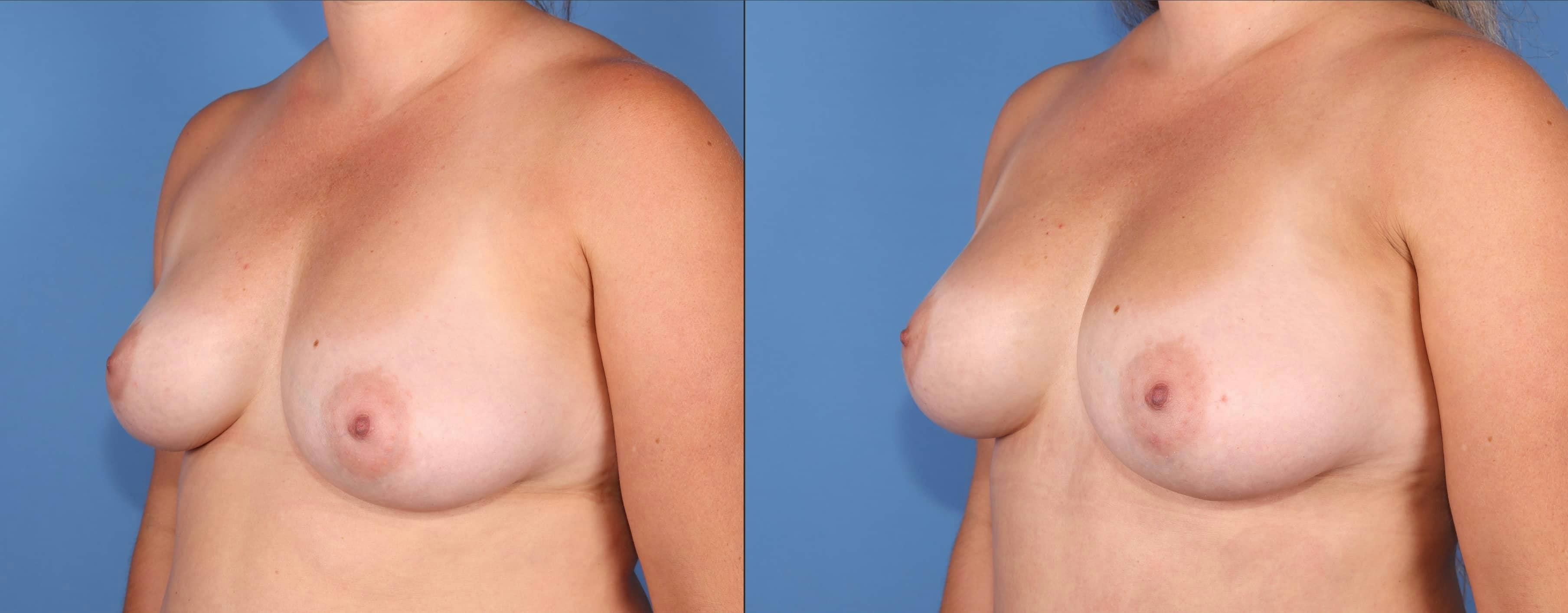 Fat Transfer Breast Augmentation Before & After Gallery - Patient 162007 - Image 3
