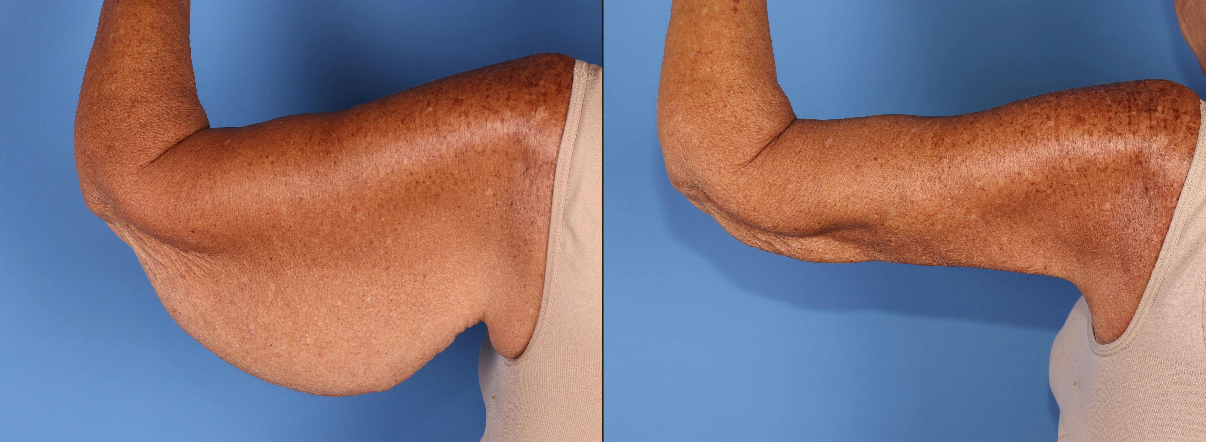 Arm Lift Before & After Gallery - Patient 497970 - Image 1