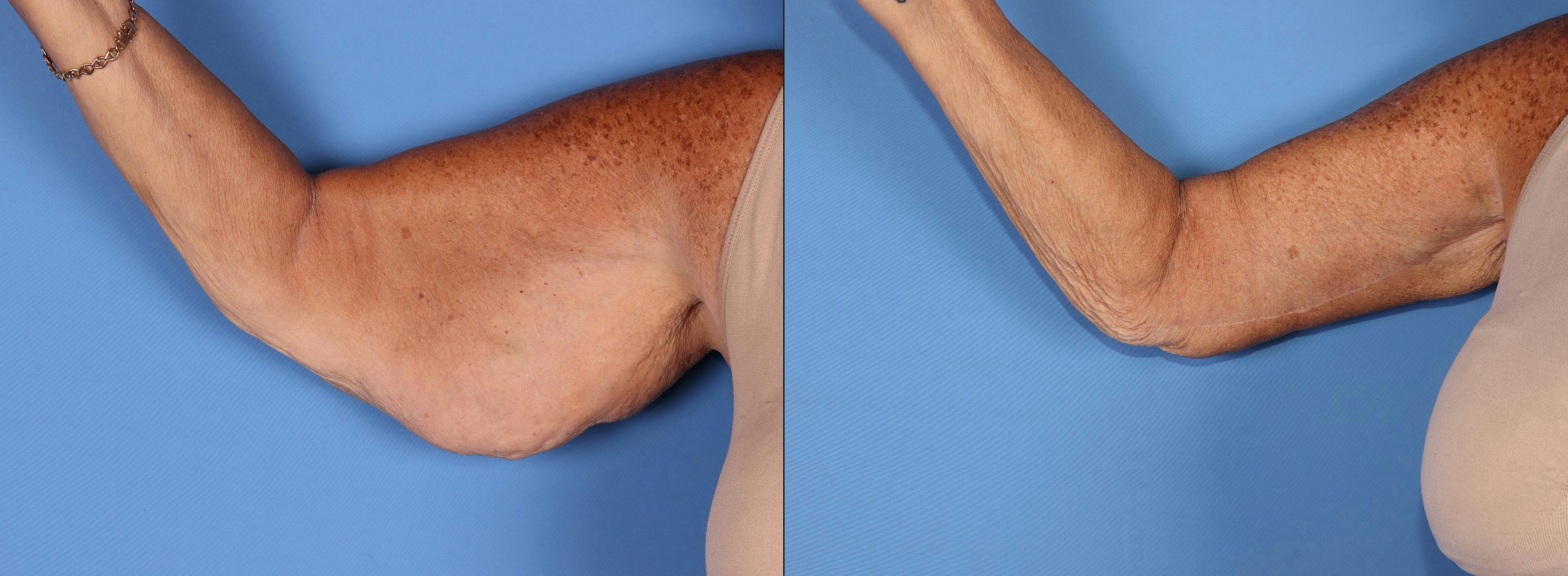 Arm Lift Before & After Gallery - Patient 588435 - Image 2