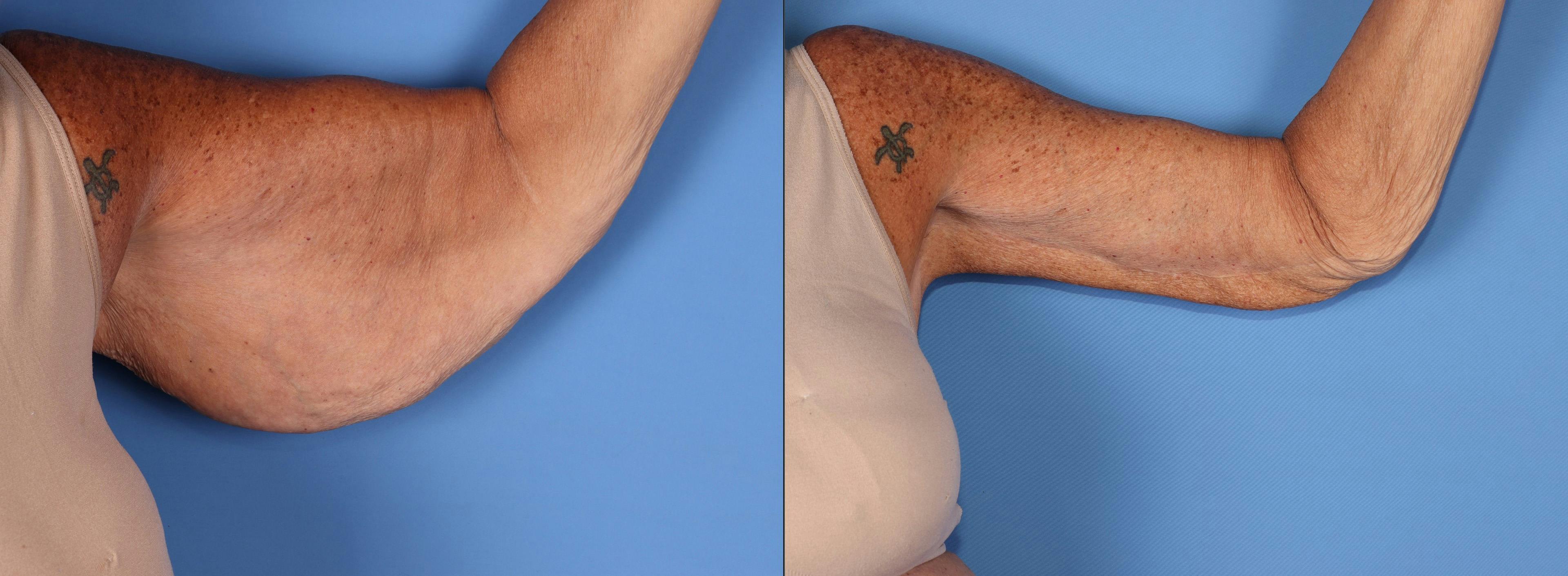 Arm Lift Before & After Gallery - Patient 497970 - Image 3