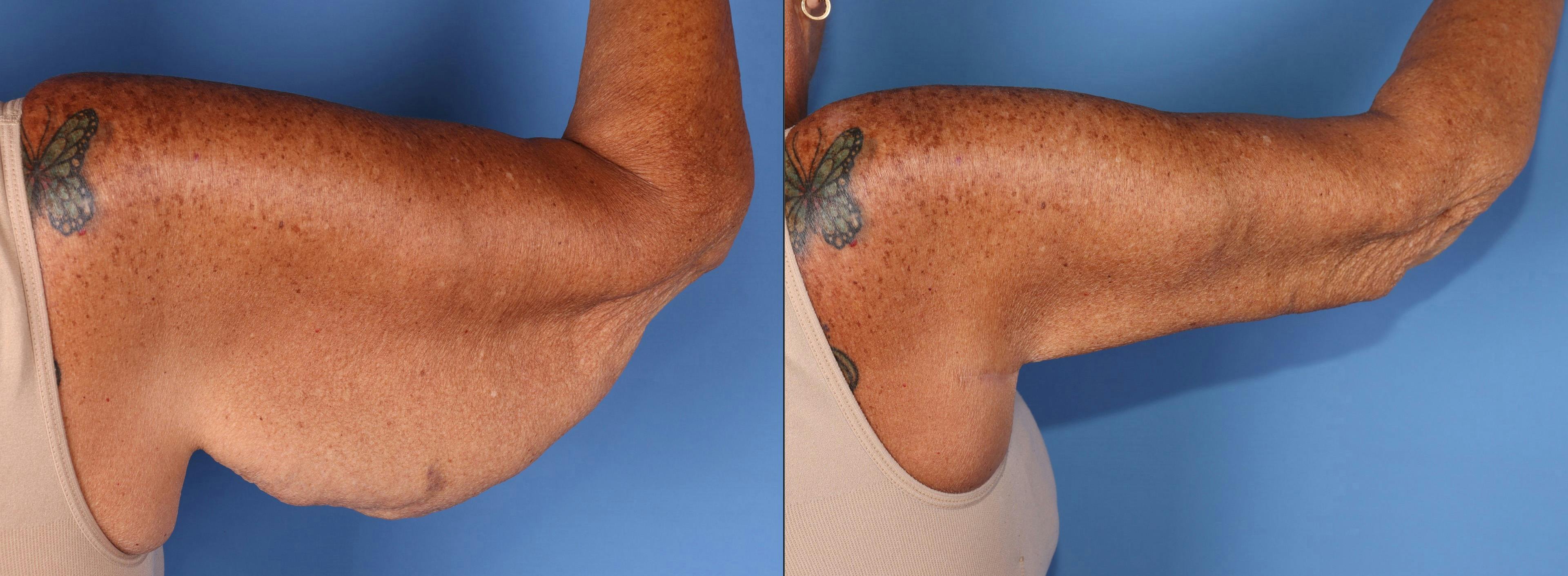 Arm Lift Before & After Gallery - Patient 588435 - Image 4