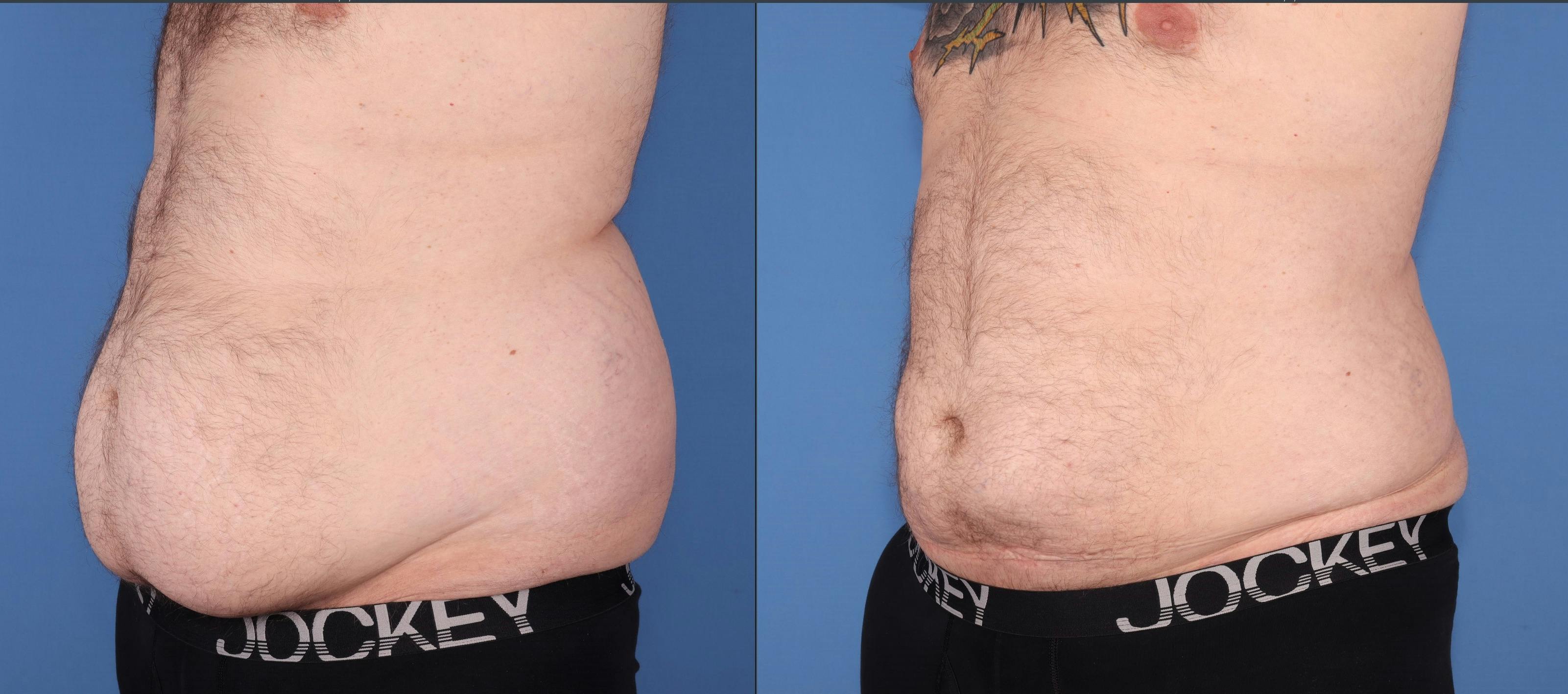 Abdomen Before & After Gallery - Patient 203535 - Image 4