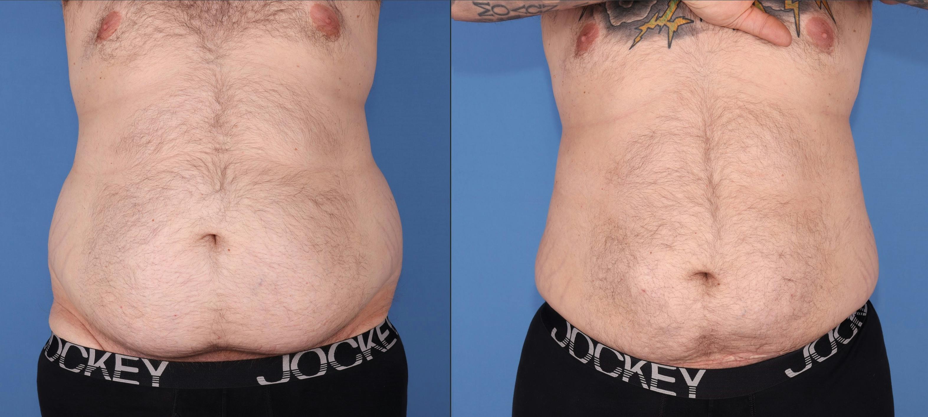 Abdomen Before & After Gallery - Patient 203535 - Image 1