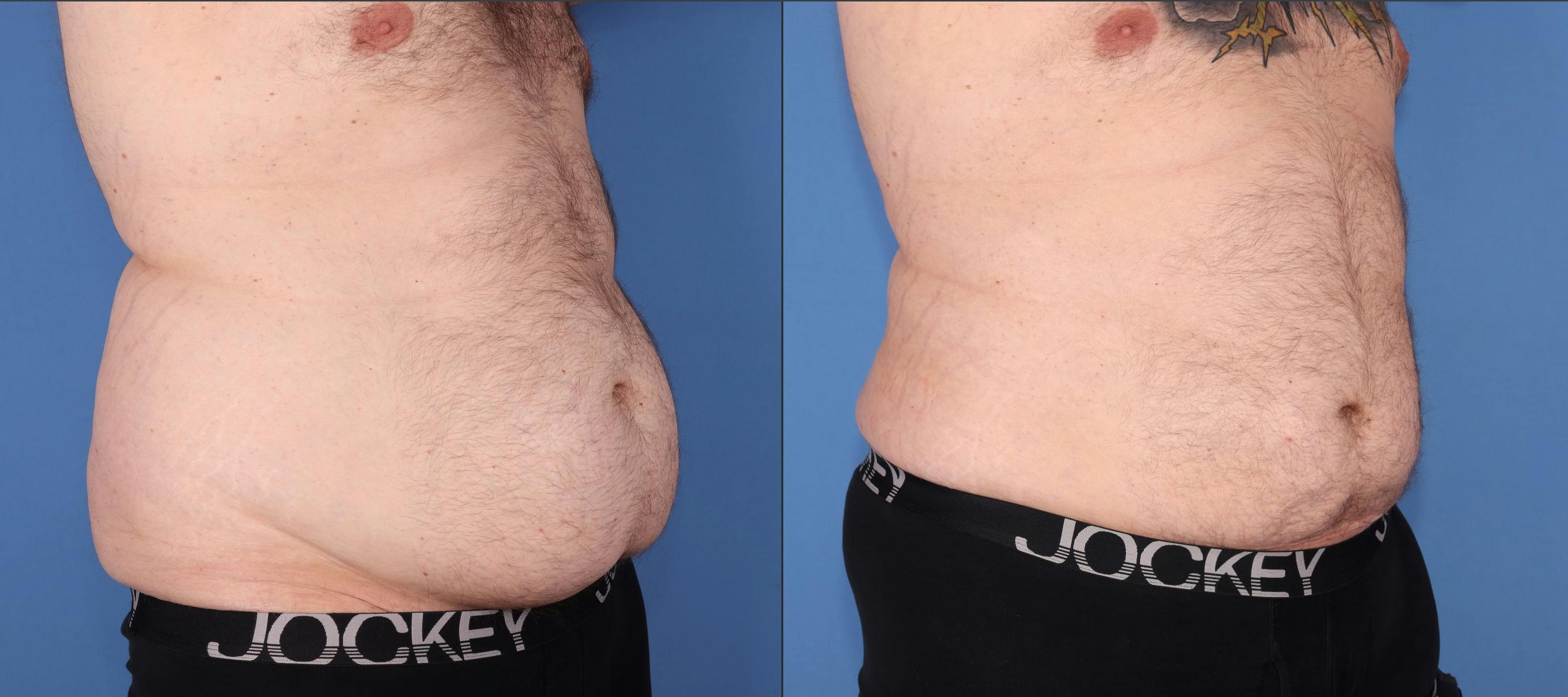 Abdomen Before & After Gallery - Patient 203535 - Image 2
