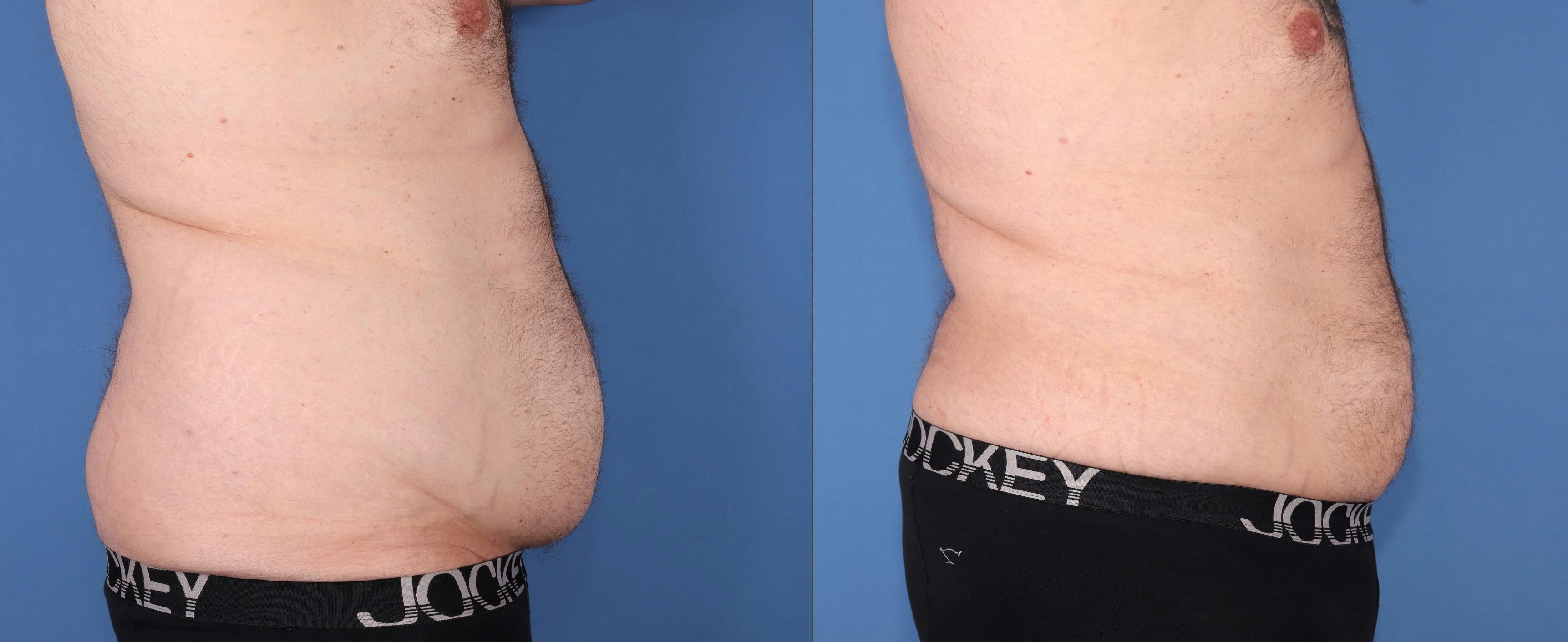 Abdomen Before & After Gallery - Patient 203535 - Image 3