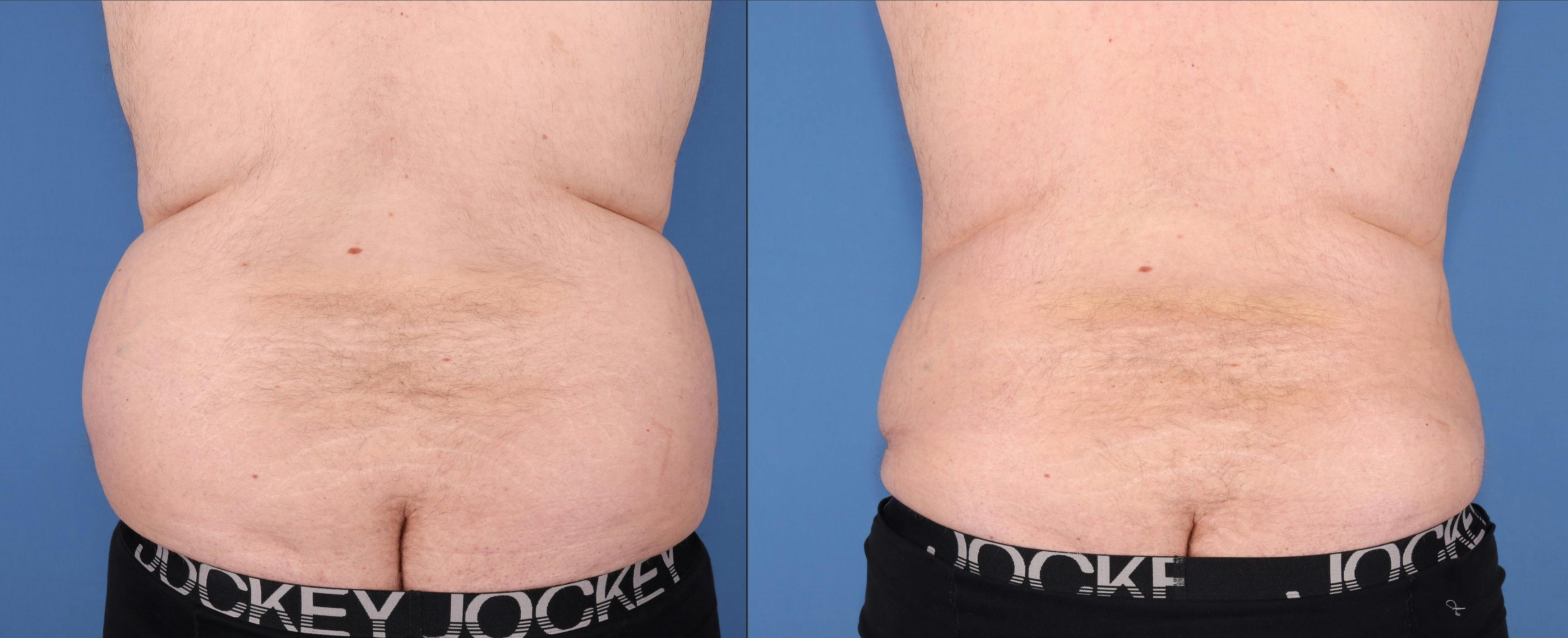Abdomen Before & After Gallery - Patient 203535 - Image 5