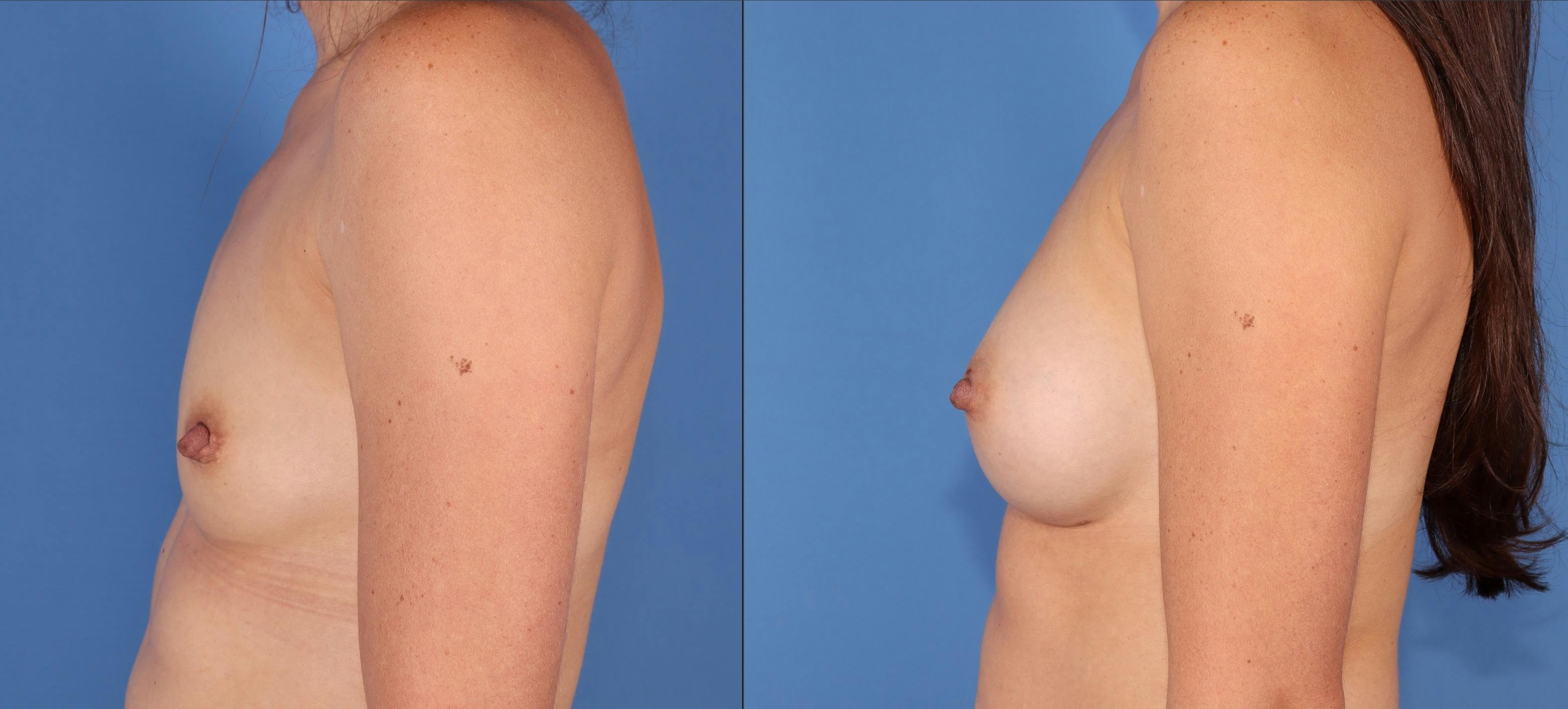 Breast Augmentation Before & After Gallery - Patient 249064 - Image 5