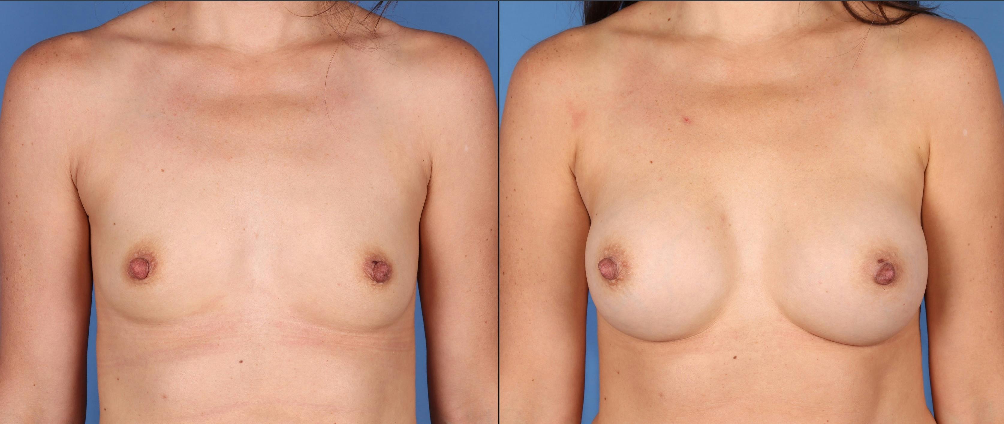 Breast Augmentation Before & After Gallery - Patient 249064 - Image 1