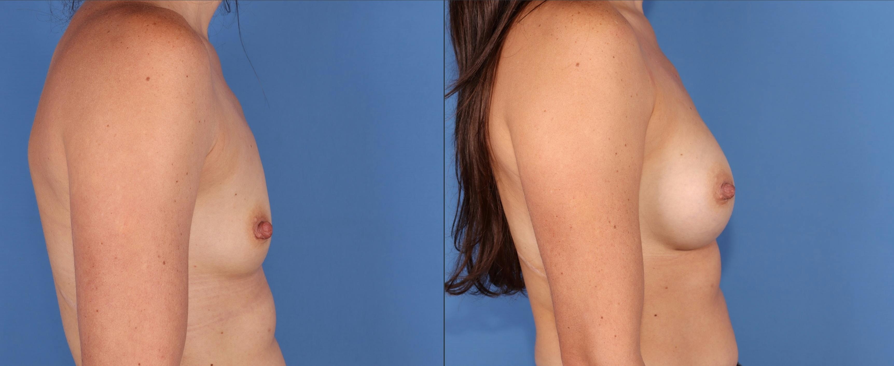 Breast Augmentation Before & After Gallery - Patient 249064 - Image 3