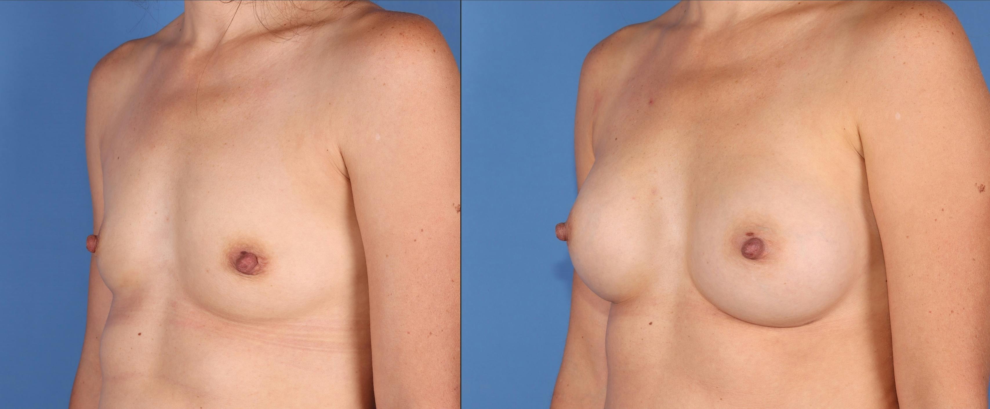 Breast Augmentation Before & After Gallery - Patient 249064 - Image 4