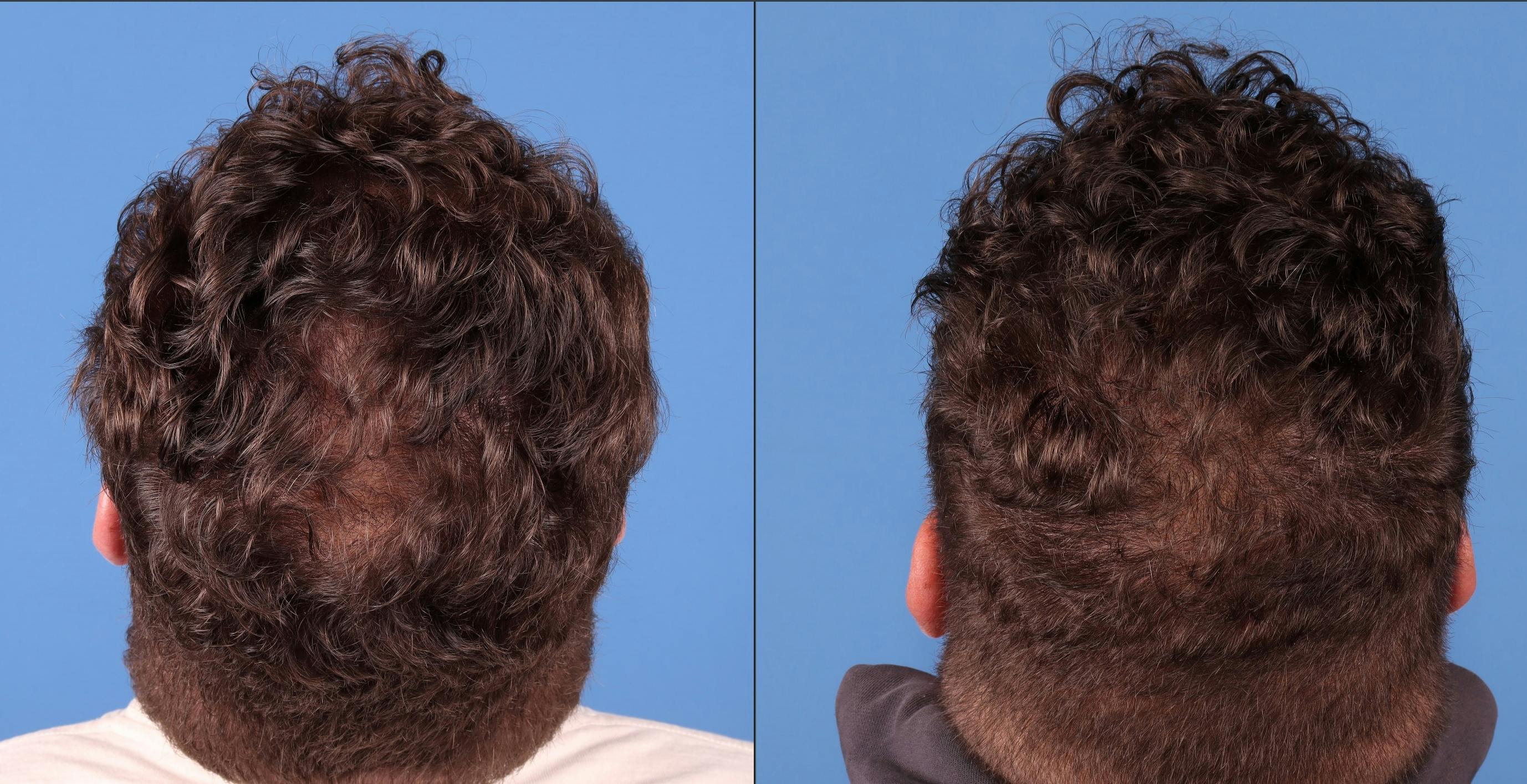 NeoGraft Hair Restoration Before & After Gallery - Patient 263132 - Image 3
