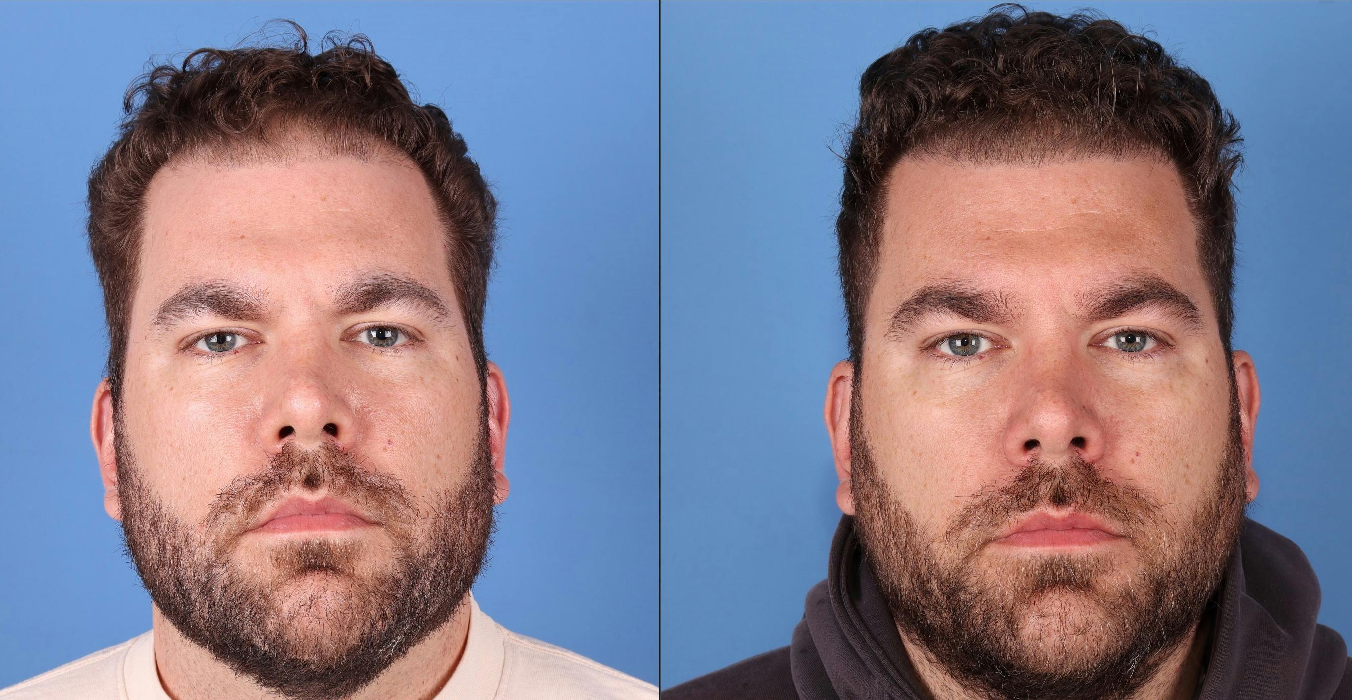 NeoGraft Hair Restoration Before & After Gallery - Patient 263132 - Image 2