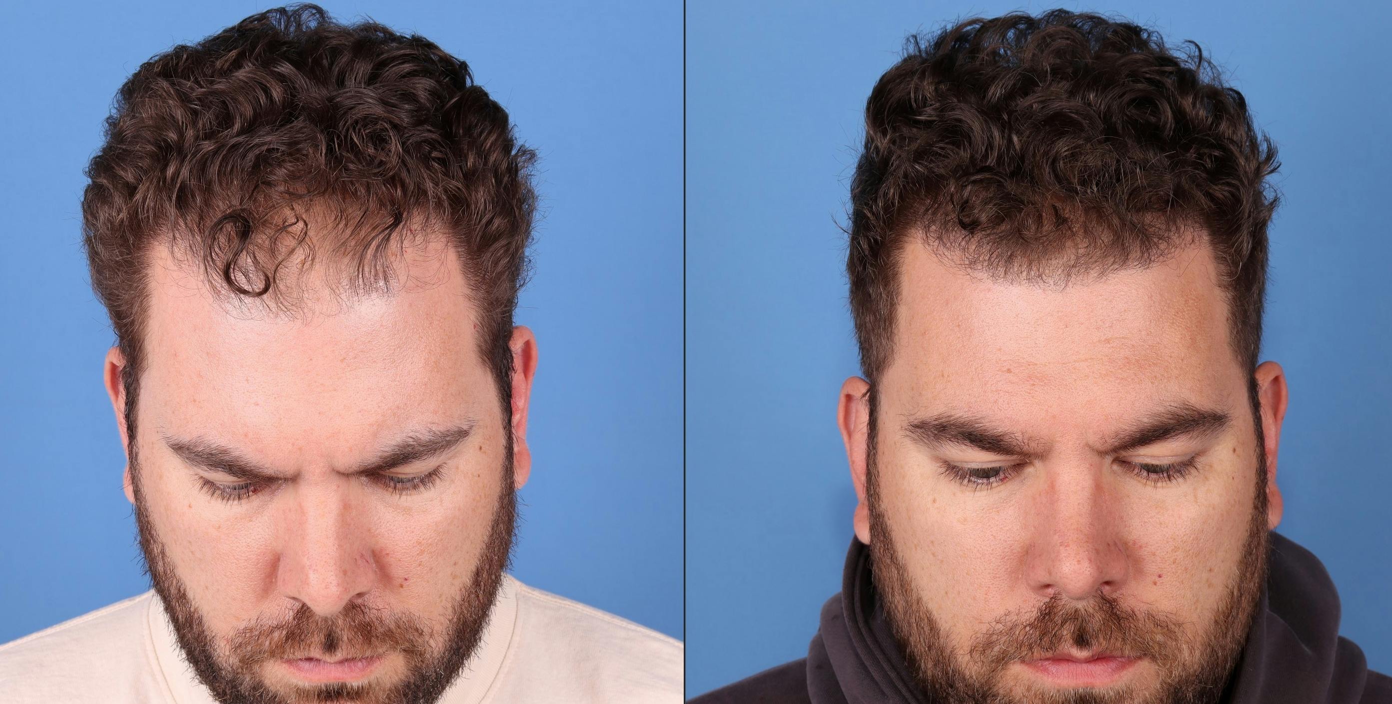 NeoGraft Hair Restoration Before & After Gallery - Patient 263132 - Image 1