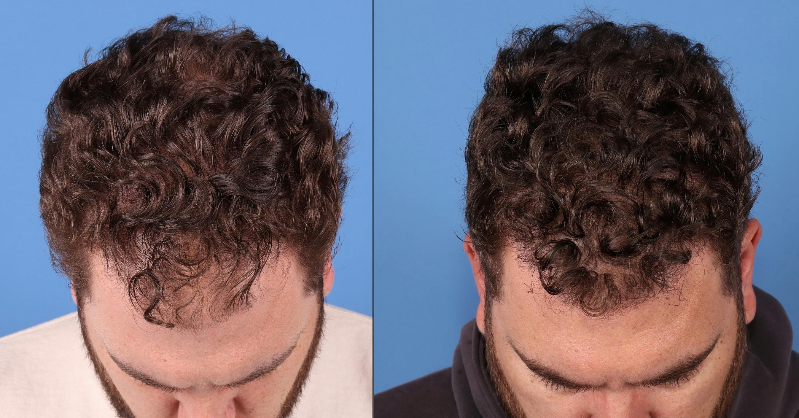 NeoGraft Hair Restoration Before & After Gallery - Patient 263132 - Image 4
