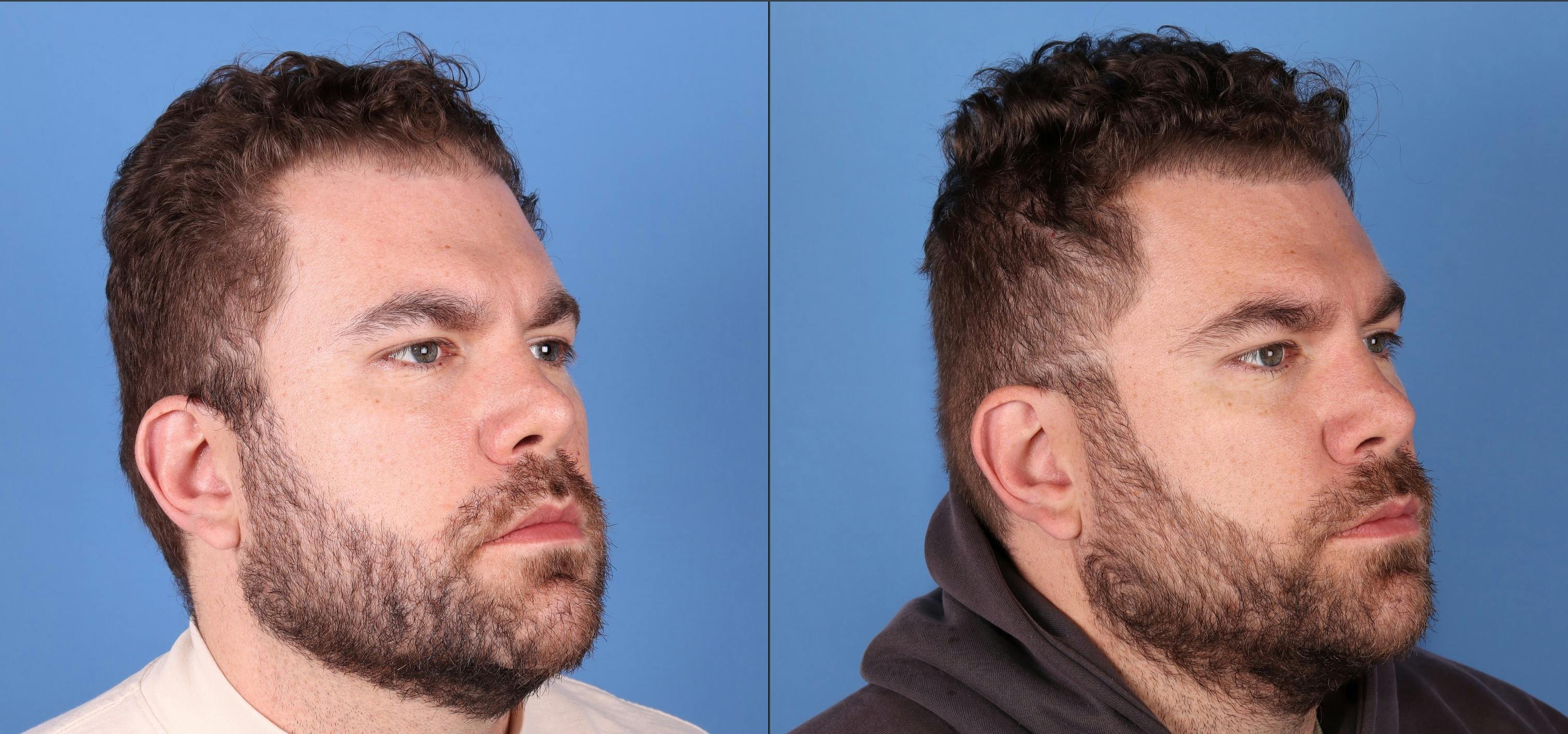 NeoGraft Hair Restoration Before & After Gallery - Patient 263132 - Image 5