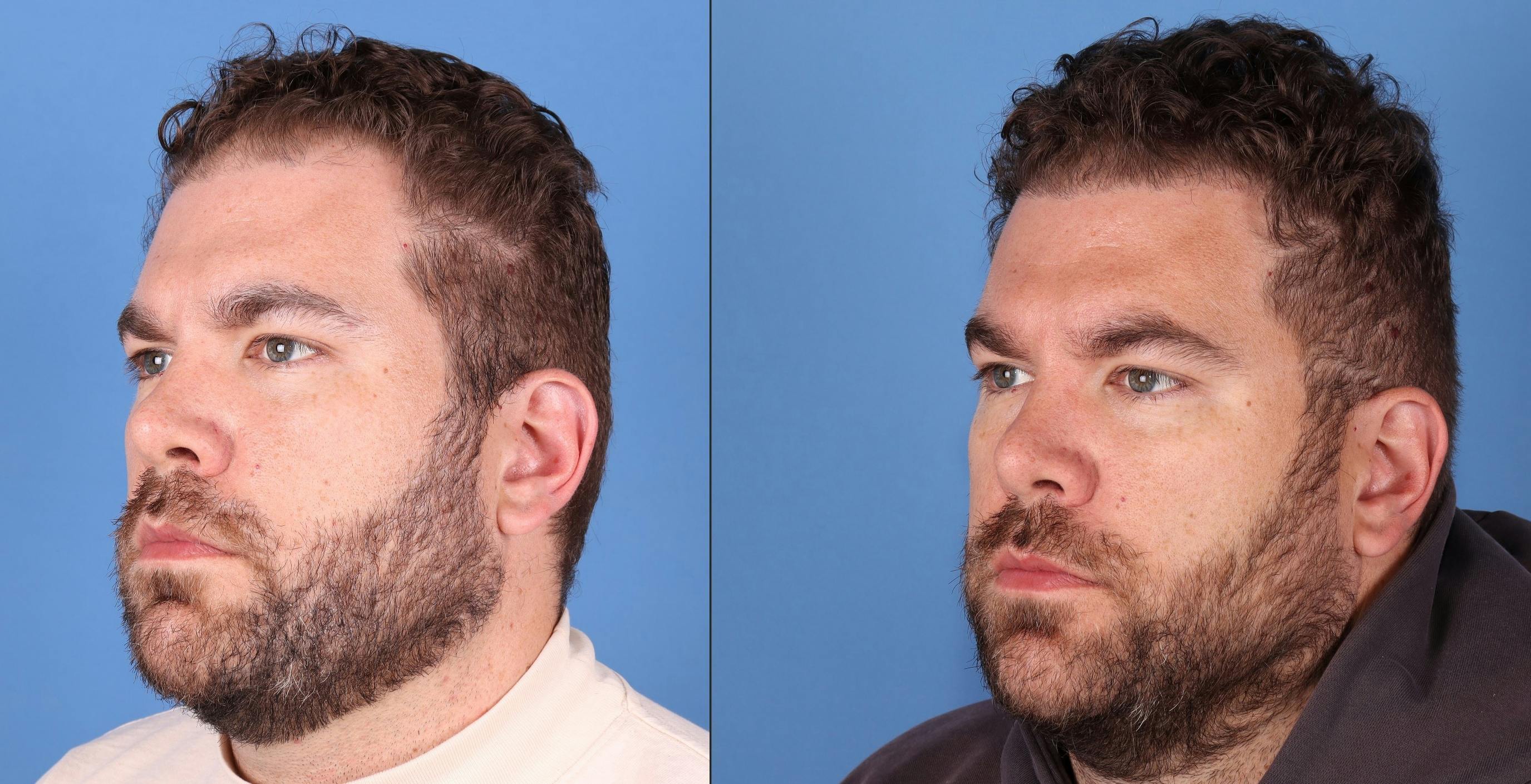 NeoGraft Hair Restoration Before & After Gallery - Patient 263132 - Image 6