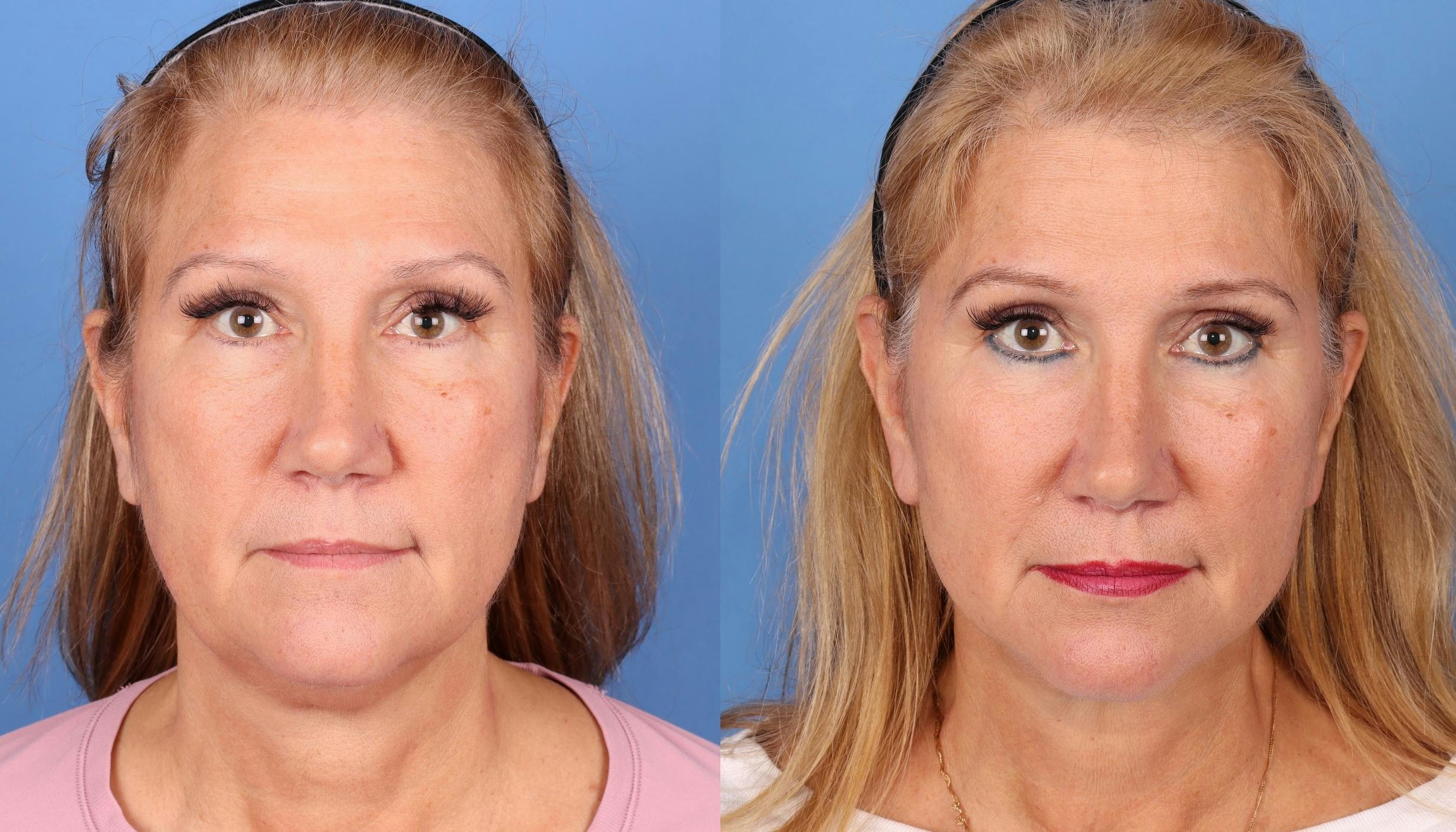Face Lift Before & After Gallery - Patient 344123 - Image 1