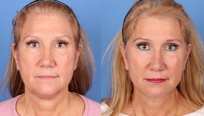 Face Lift Before & After Gallery - Patient 344123 - Image 1