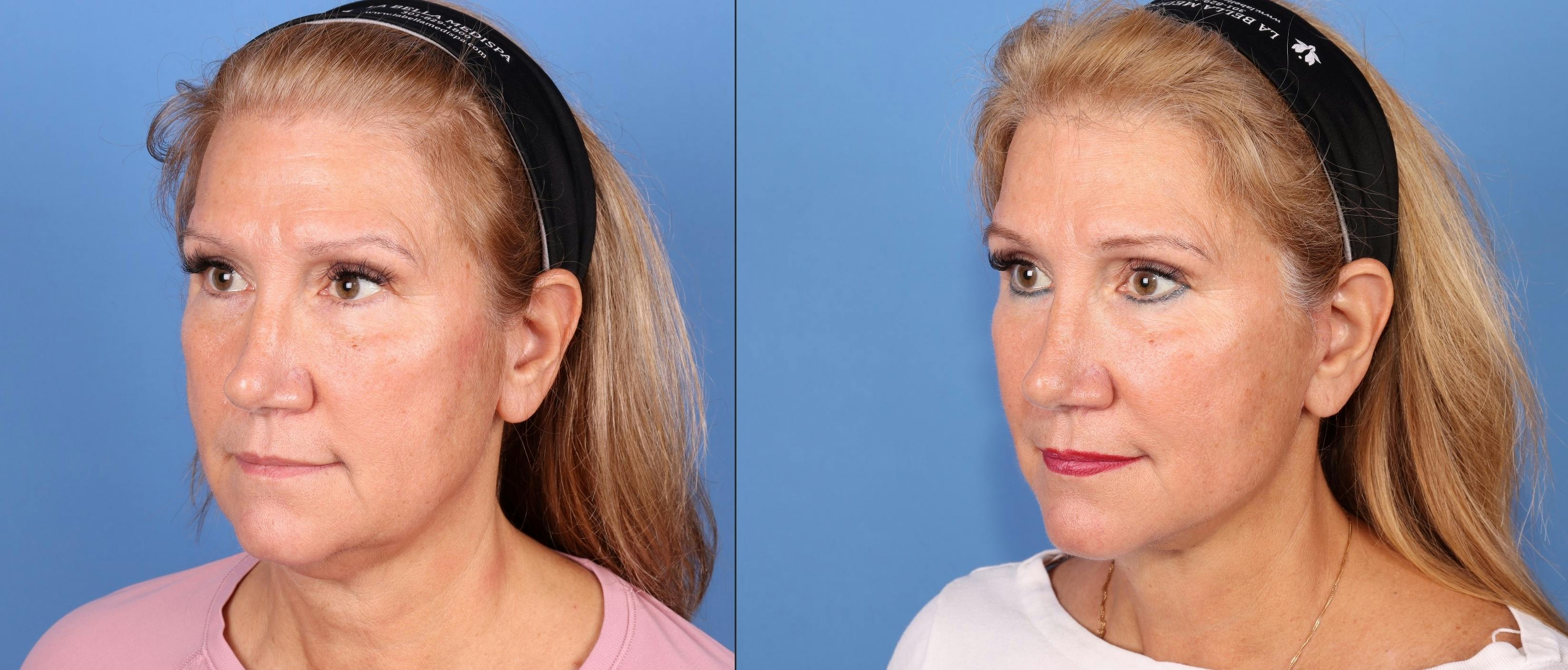 Neck Lift Before & After Gallery - Patient 863479 - Image 3