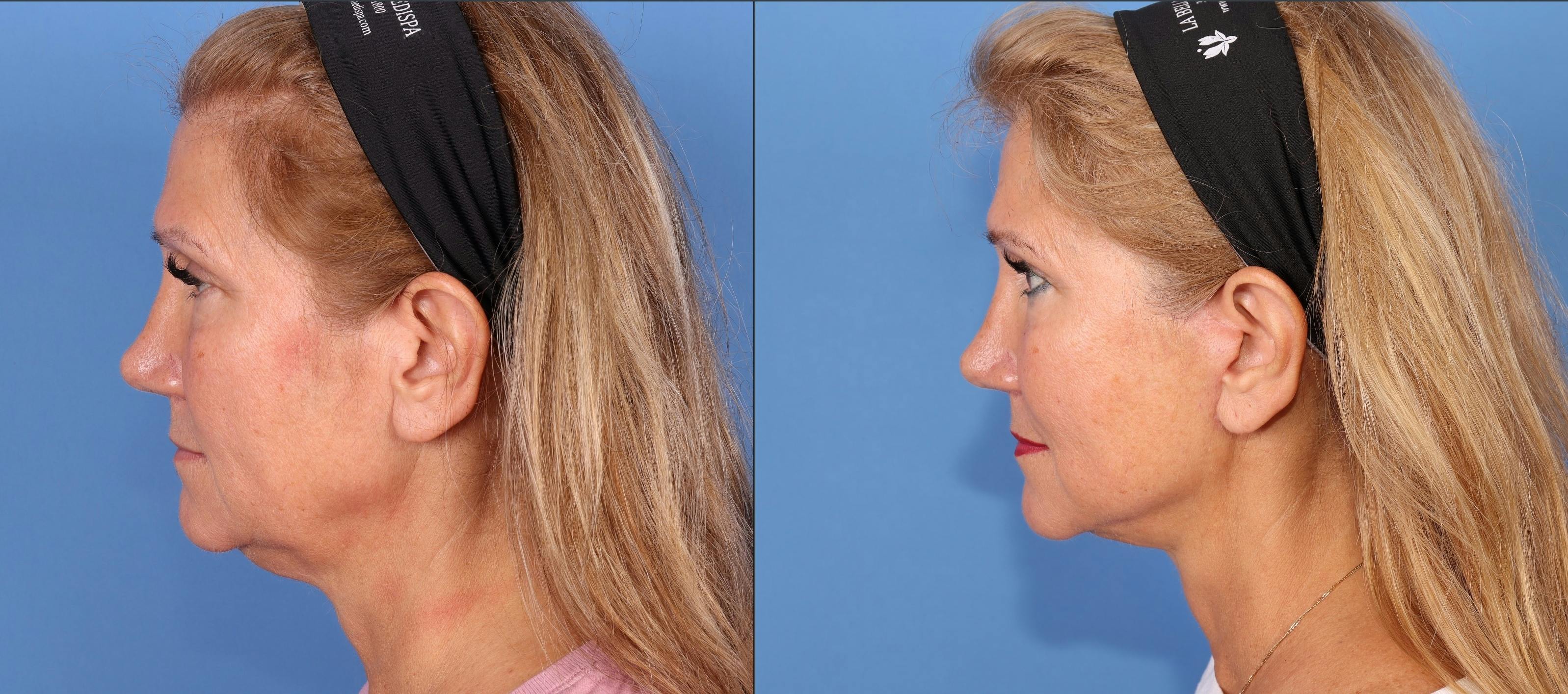 Face Lift Before & After Gallery - Patient 344123 - Image 3