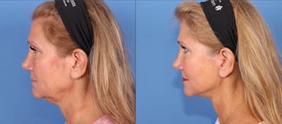 Neck Lift Before & After Gallery - Patient 863479 - Image 1