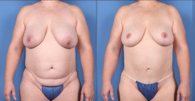 Mommy Makeover Before & After Gallery - Patient 197850 - Image 1