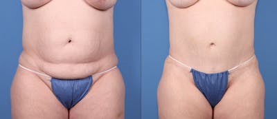 Tummy Tuck Before & After Gallery - Patient 371811 - Image 1