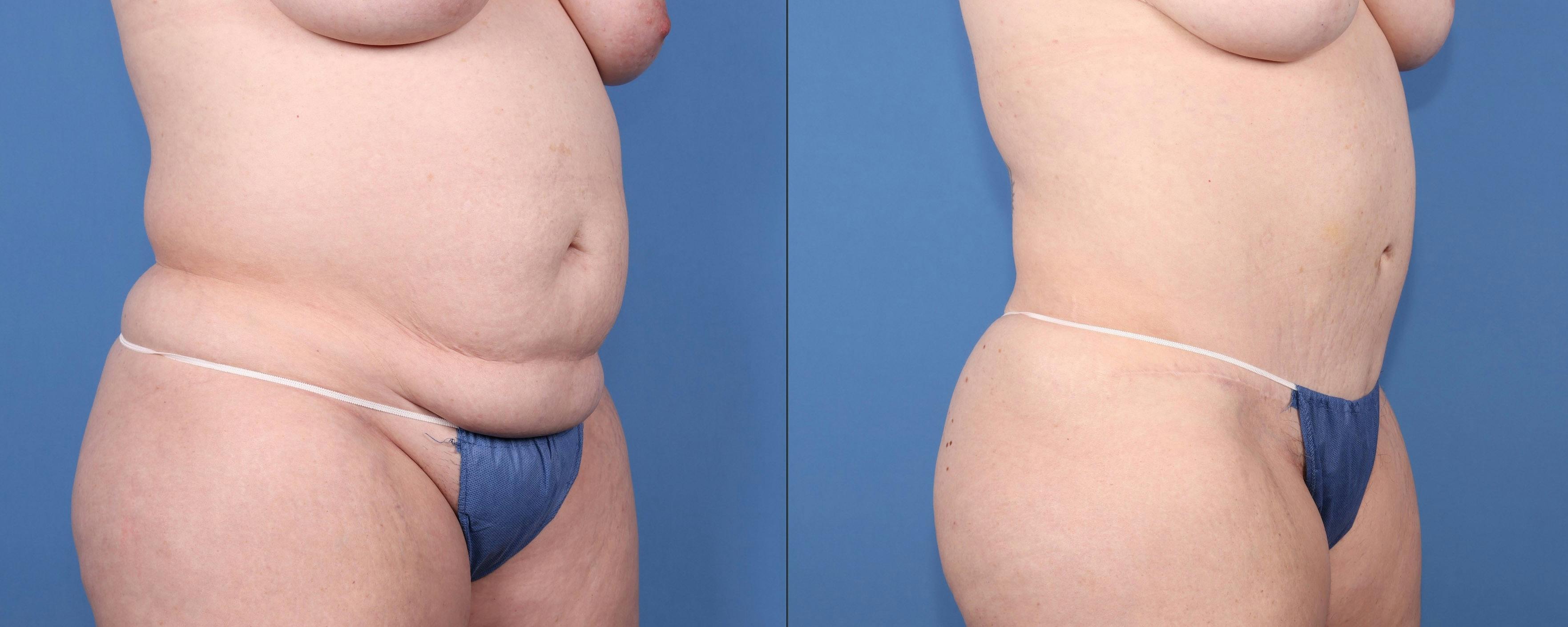 Tummy Tuck Before & After Gallery - Patient 371811 - Image 2