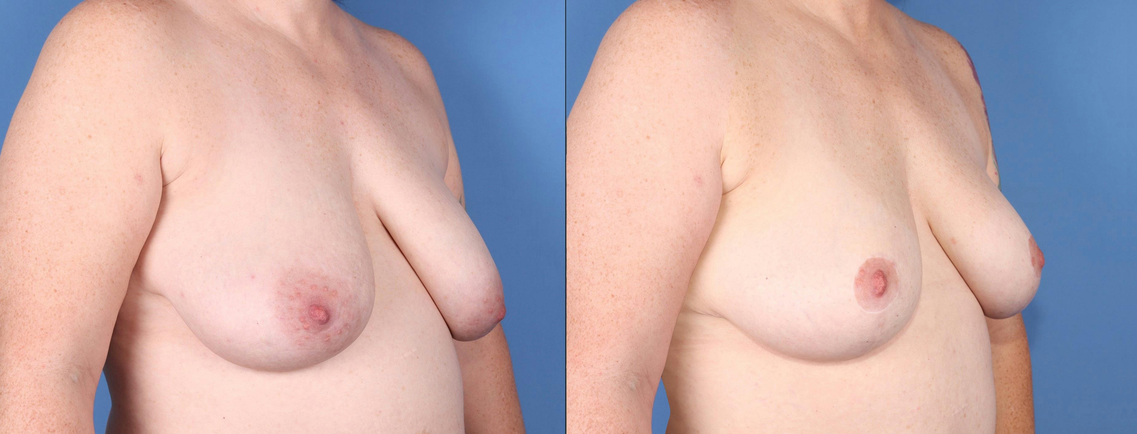 Breast Lift Before & After Gallery - Patient 392226 - Image 2