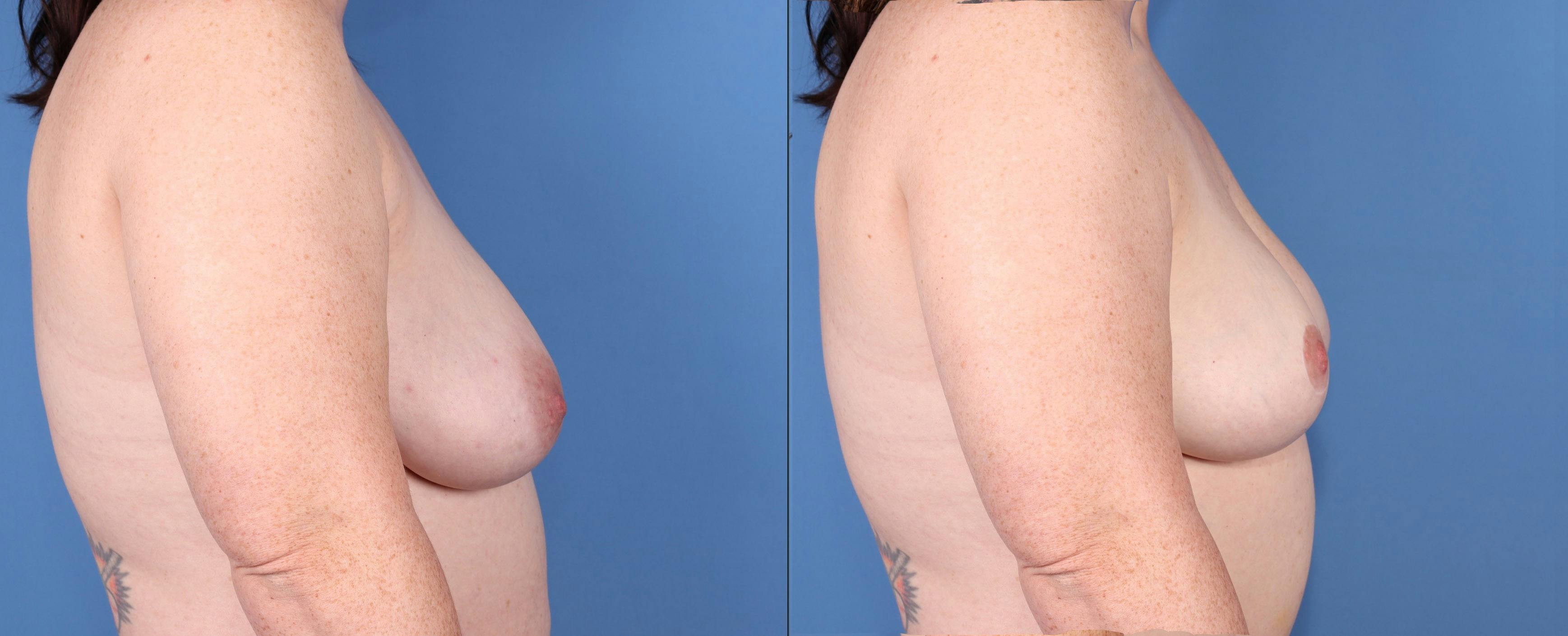 Breast Lift Before & After Gallery - Patient 392226 - Image 3