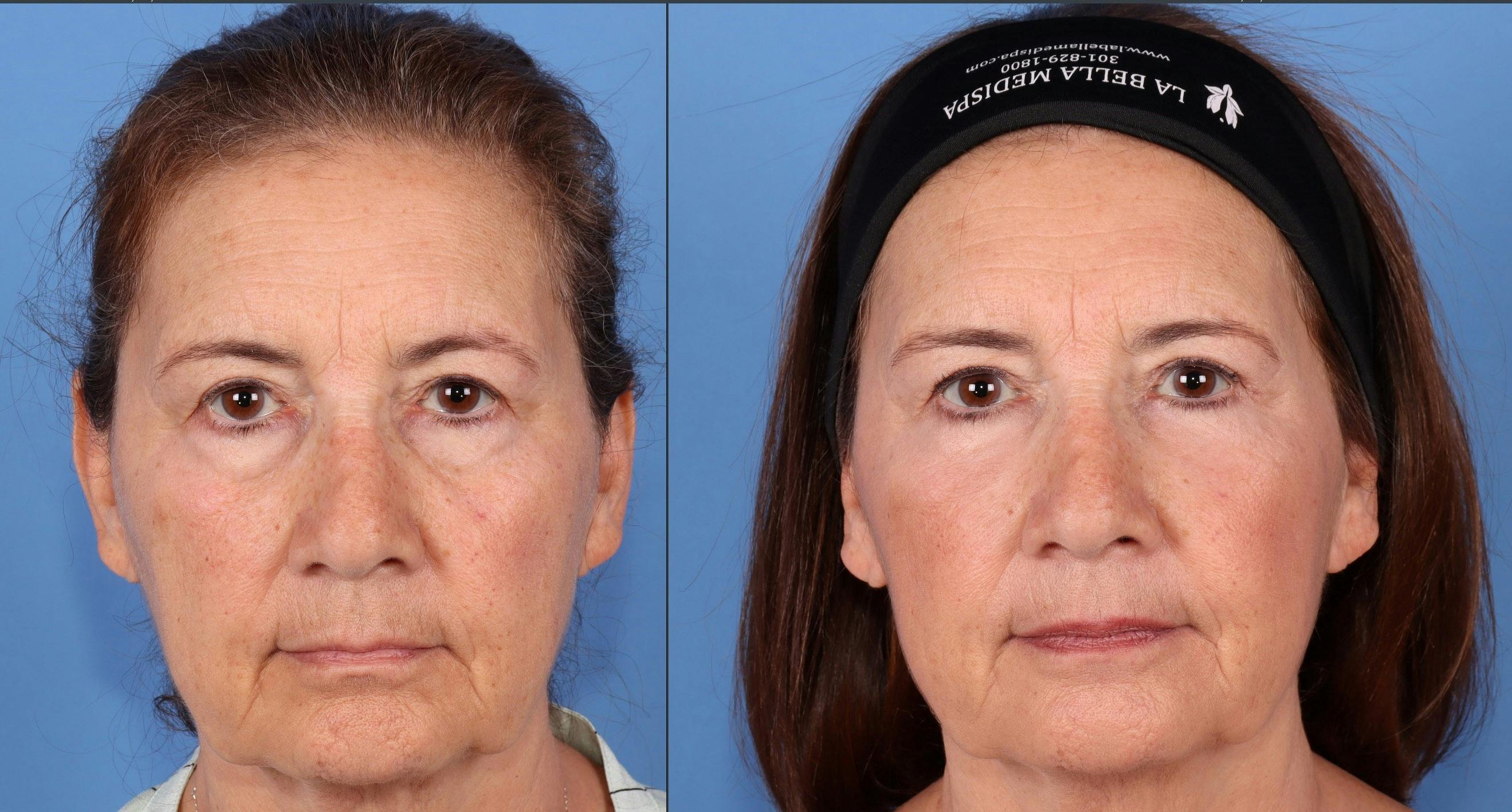 Eyelid Surgery (Blepharoplasty) Before & After Gallery - Patient 139459 - Image 1