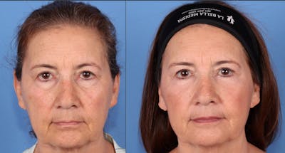 Eyelid Surgery (Upper & Lower Blepharoplasty) Before & After Gallery - Patient 143207 - Image 1
