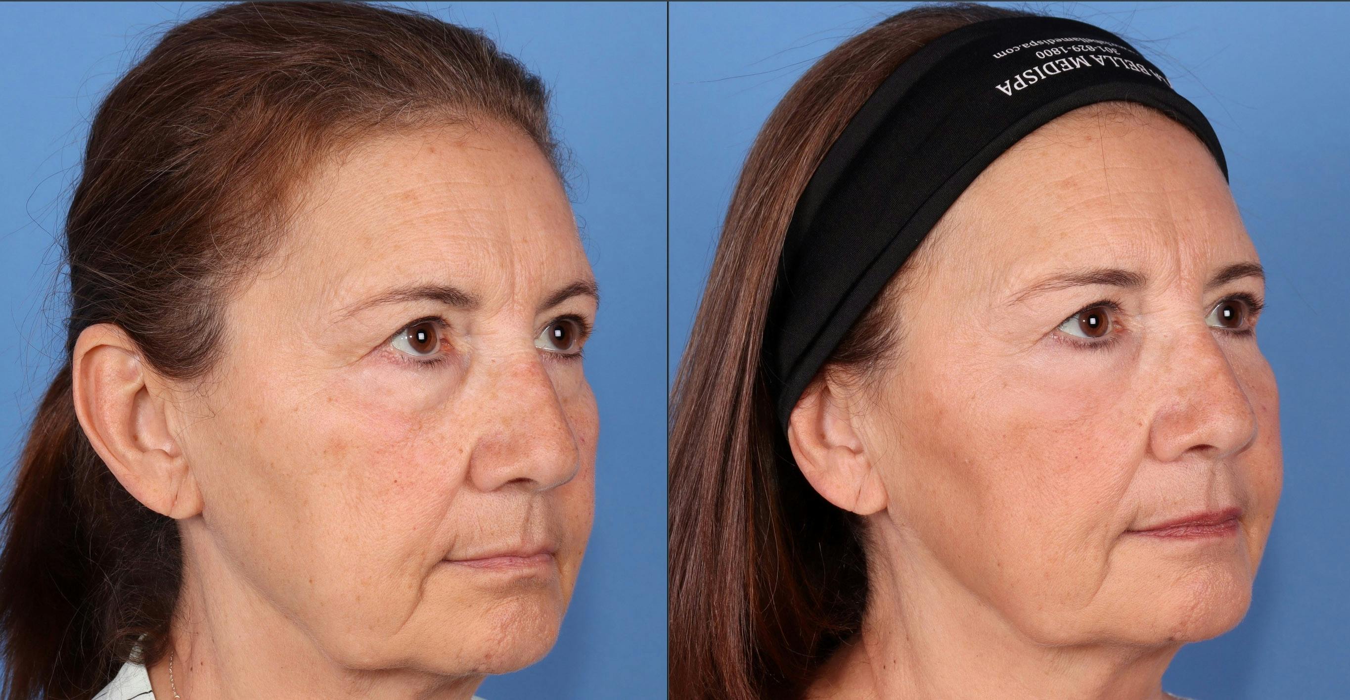 Fat Grafting Before & After Gallery - Patient 412875 - Image 2