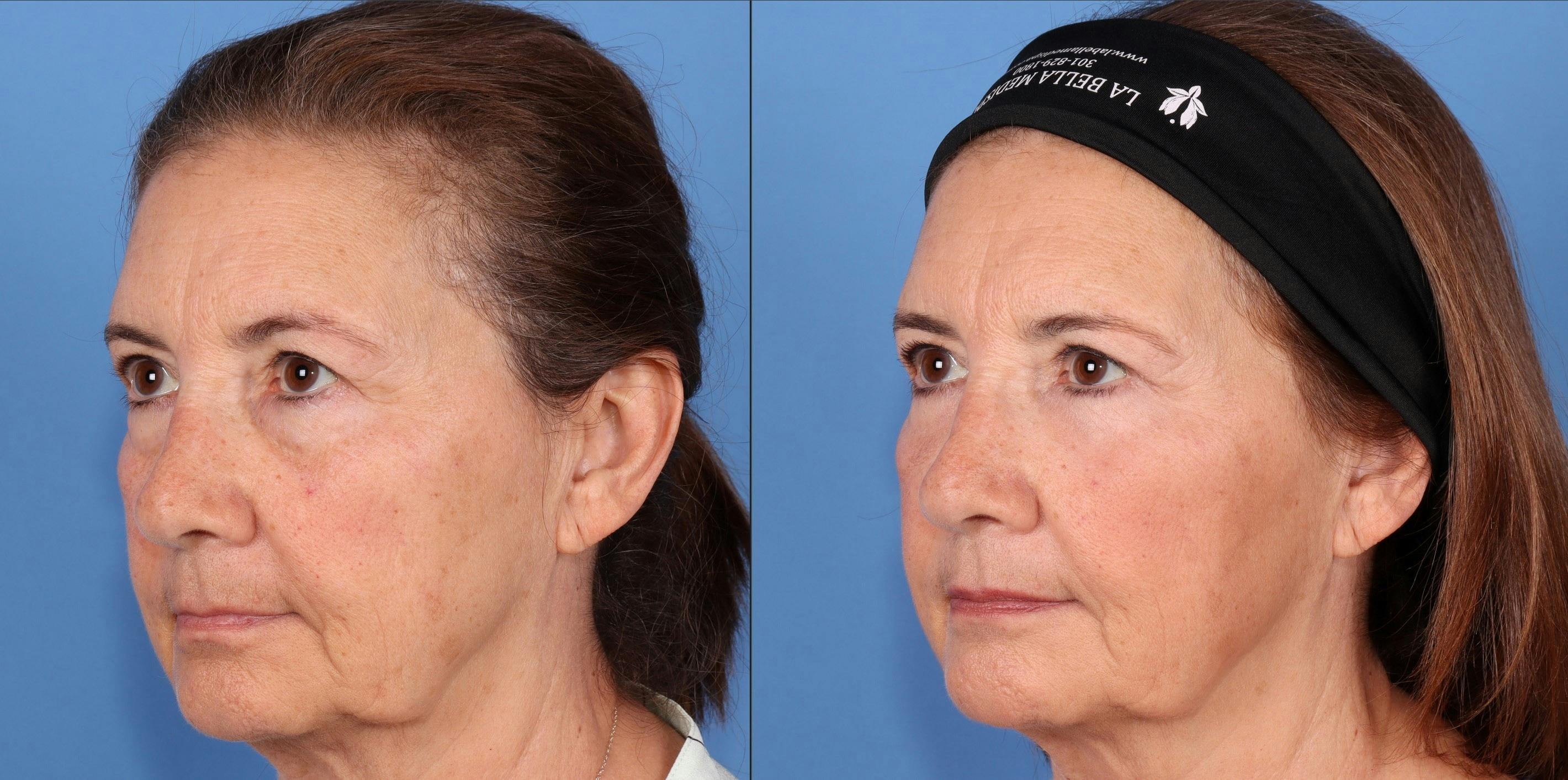 Eyelid Surgery (Blepharoplasty) Before & After Gallery - Patient 139459 - Image 3