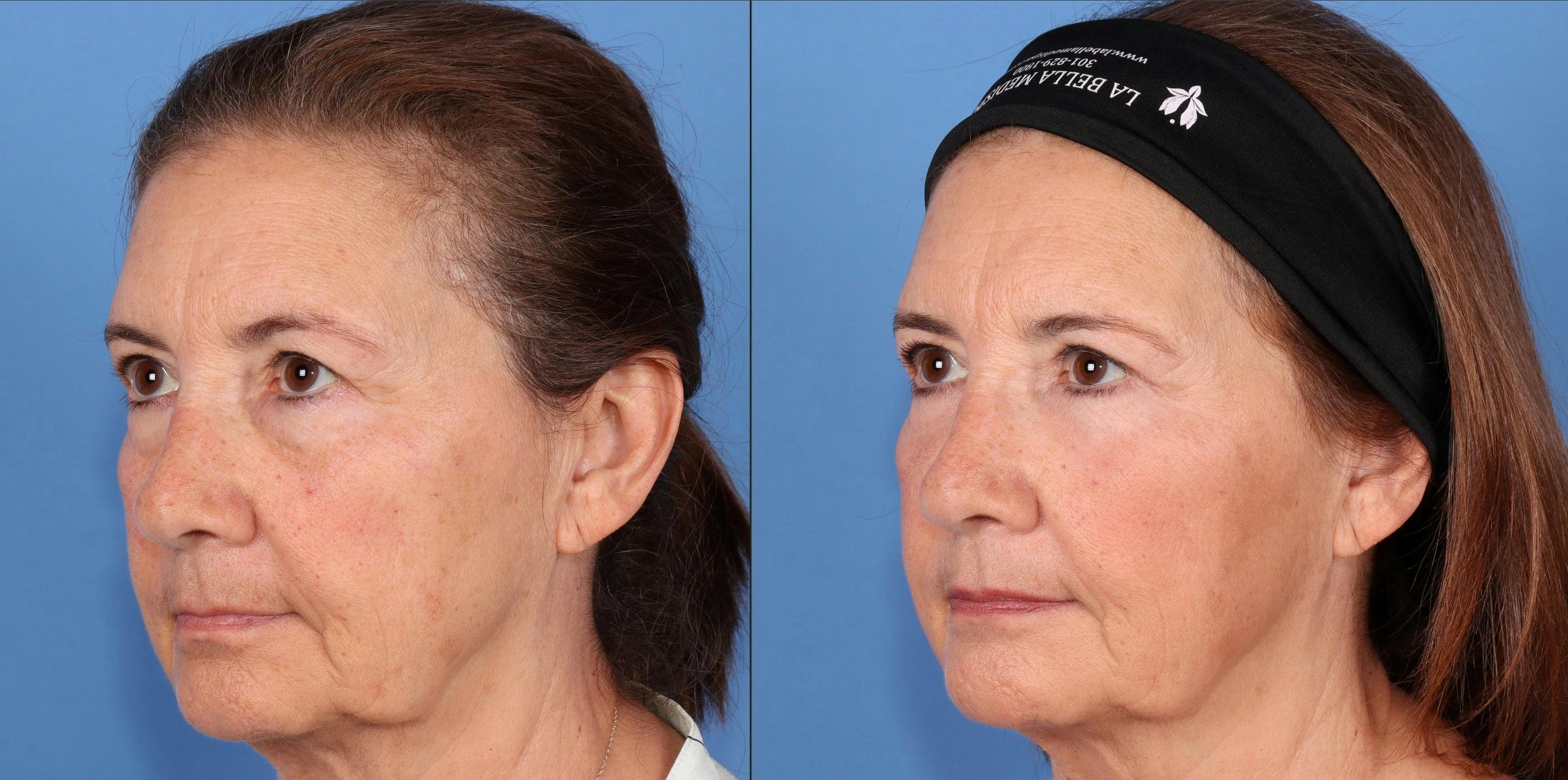 Fat Grafting Before & After Gallery - Patient 412875 - Image 3