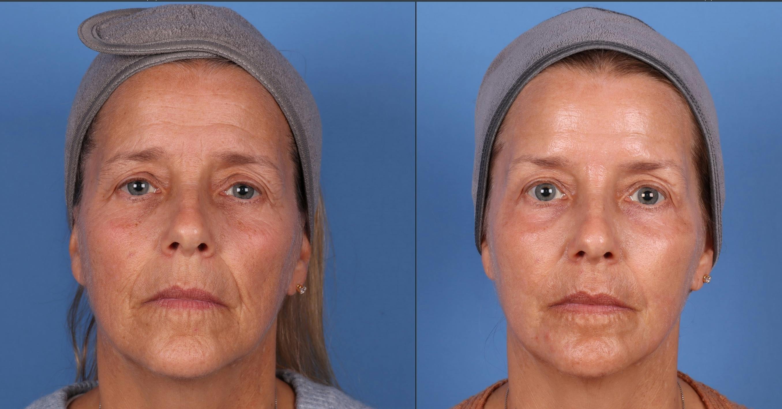 Eyelid Surgery (Blepharoplasty) Before & After Gallery - Patient 409569 - Image 1