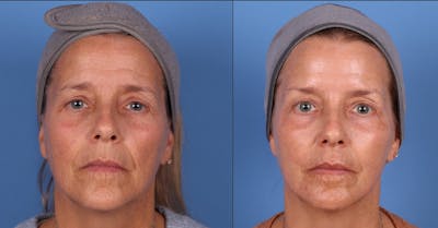 Laser Treatments Before & After Gallery - Patient 161524 - Image 1