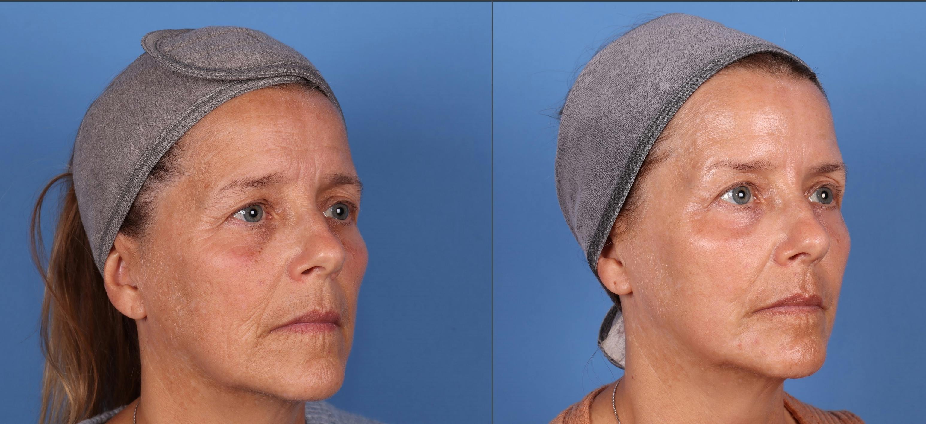 Eyelid Surgery (Blepharoplasty) Before & After Gallery - Patient 409569 - Image 2