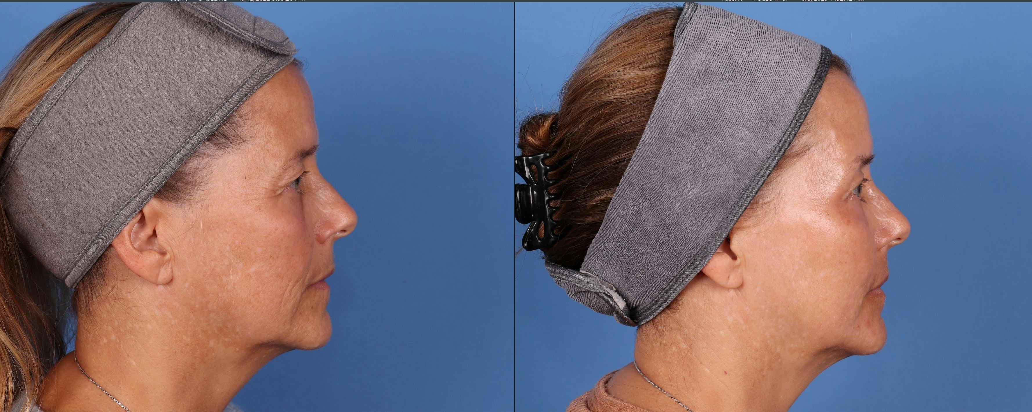 Laser Treatments Before & After Gallery - Patient 161524 - Image 3