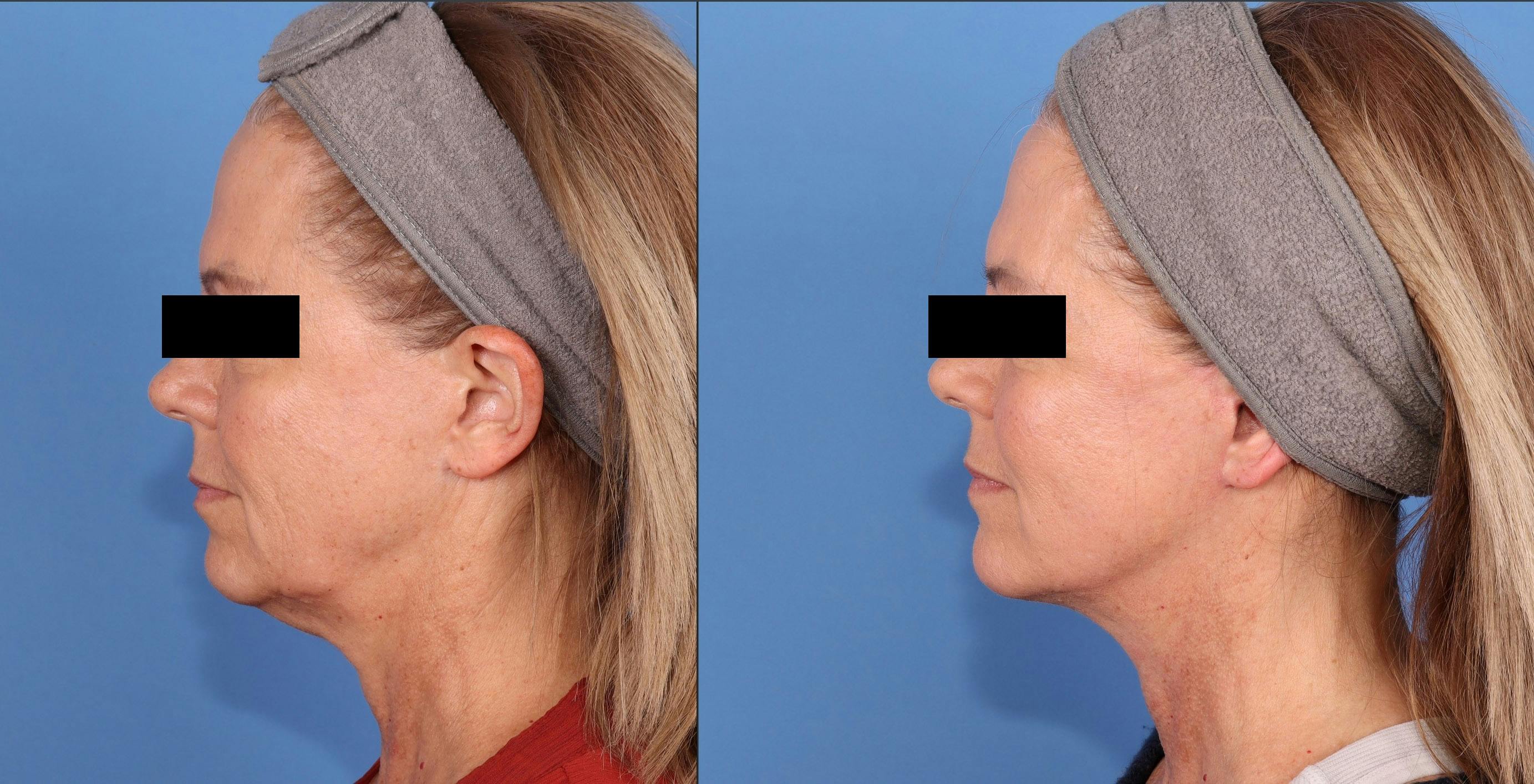 Face Lift Before & After Gallery - Patient 457525 - Image 3