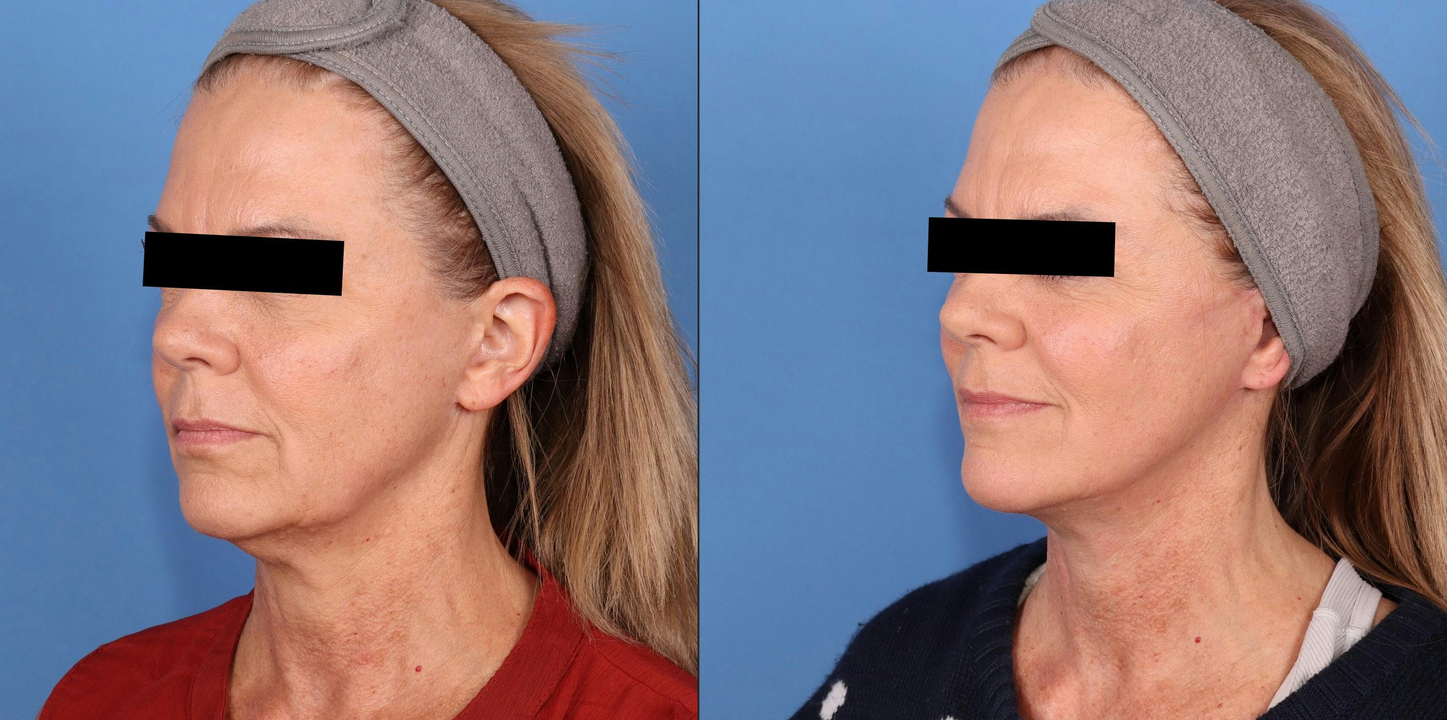 Neck Lift Before & After Gallery - Patient 391060 - Image 3
