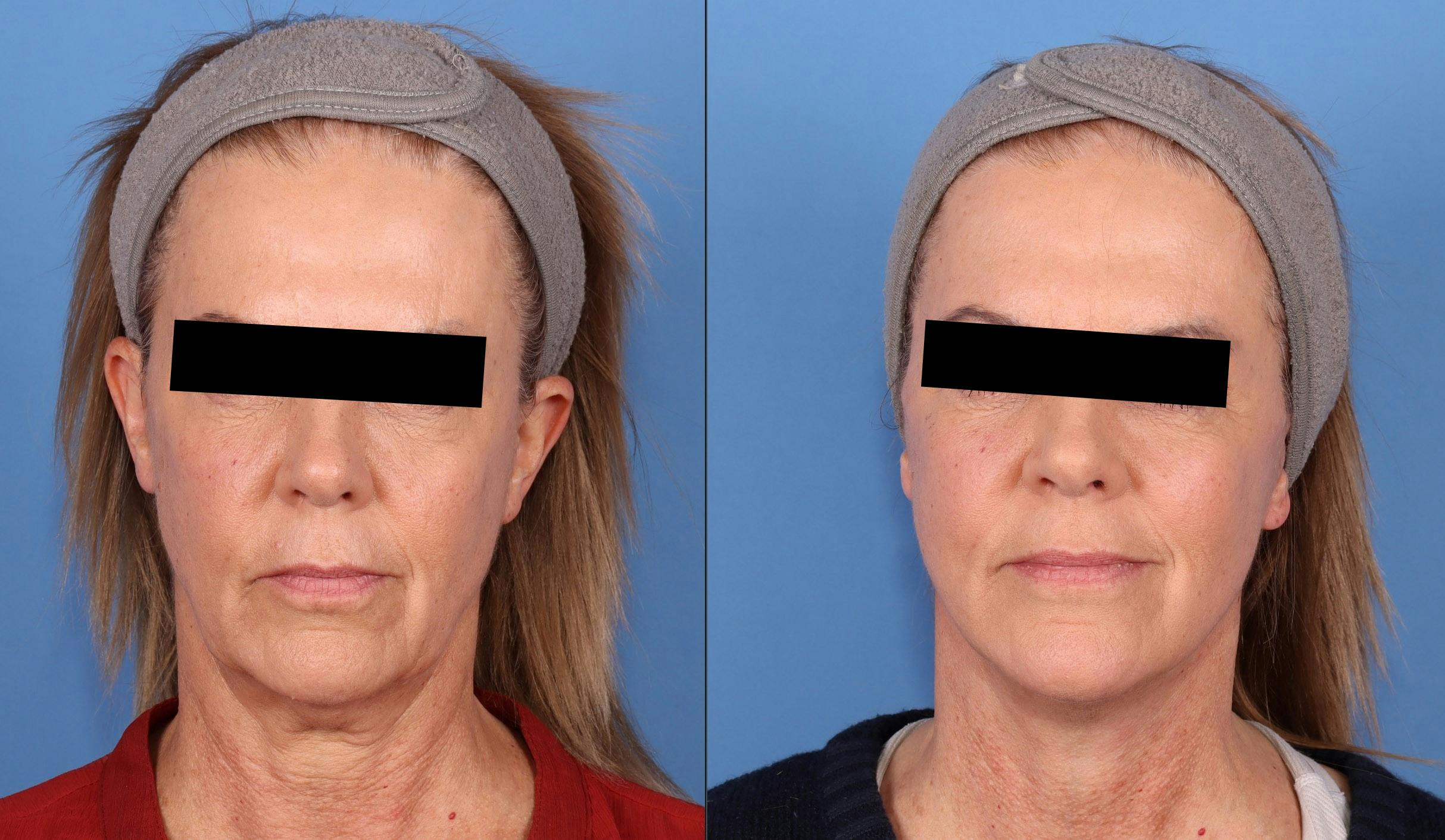 Laser Treatments Before & After Gallery - Patient 324048 - Image 1
