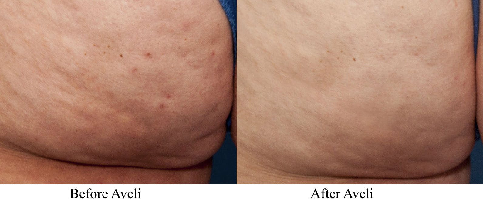 Aveli Before & After Gallery - Patient 113073 - Image 4