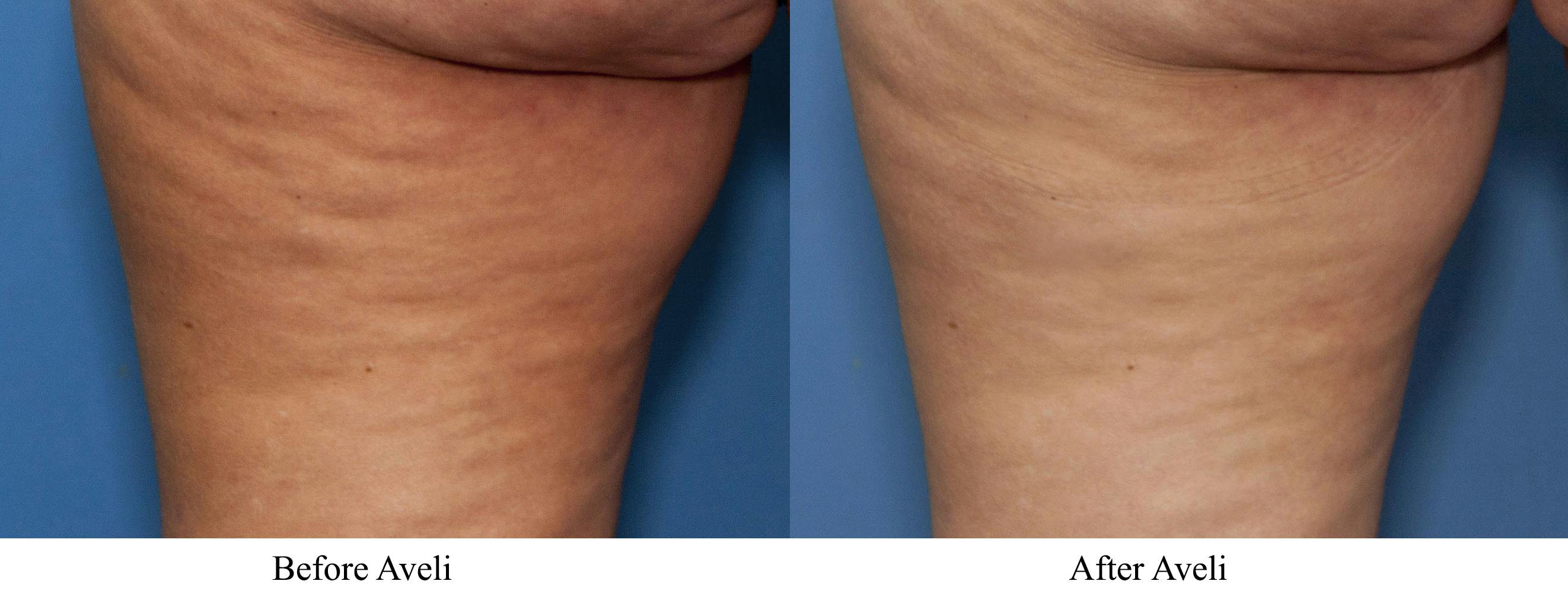 Aveli Before & After Gallery - Patient 113073 - Image 5