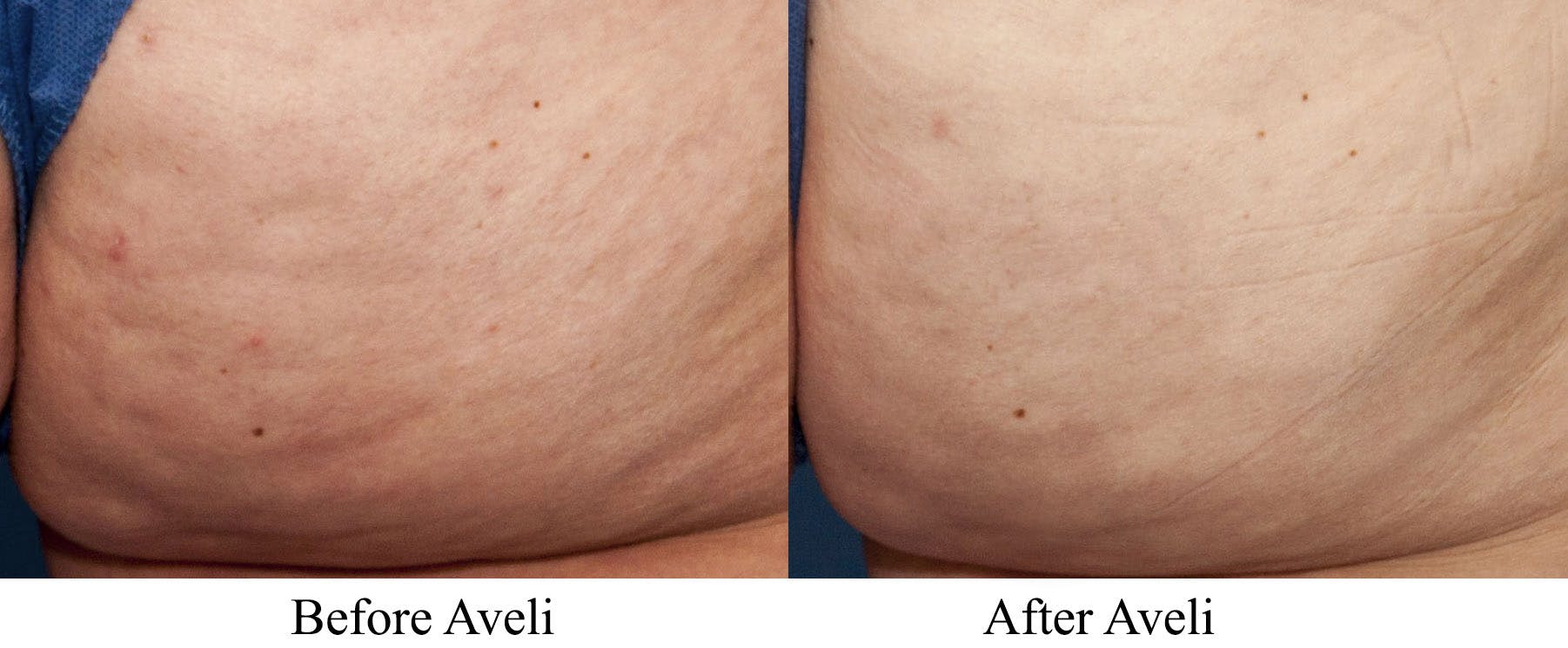 Aveli Before & After Gallery - Patient 113073 - Image 6