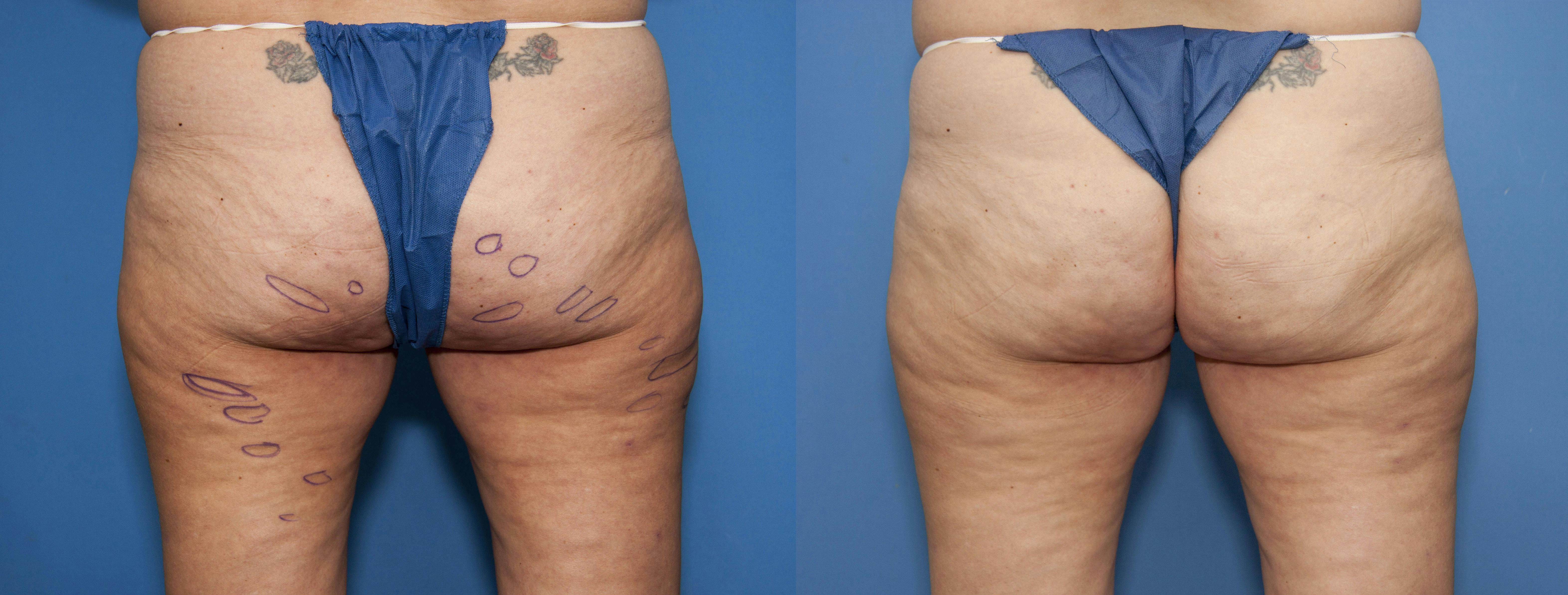 Aveli Before & After Gallery - Patient 113073 - Image 2