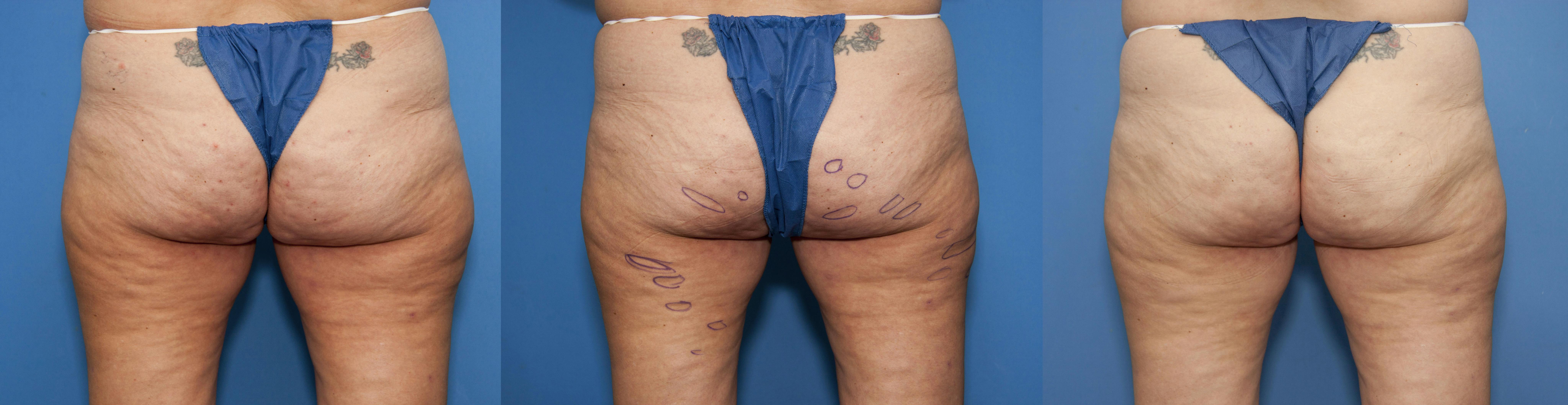 Aveli Before & After Gallery - Patient 113073 - Image 3