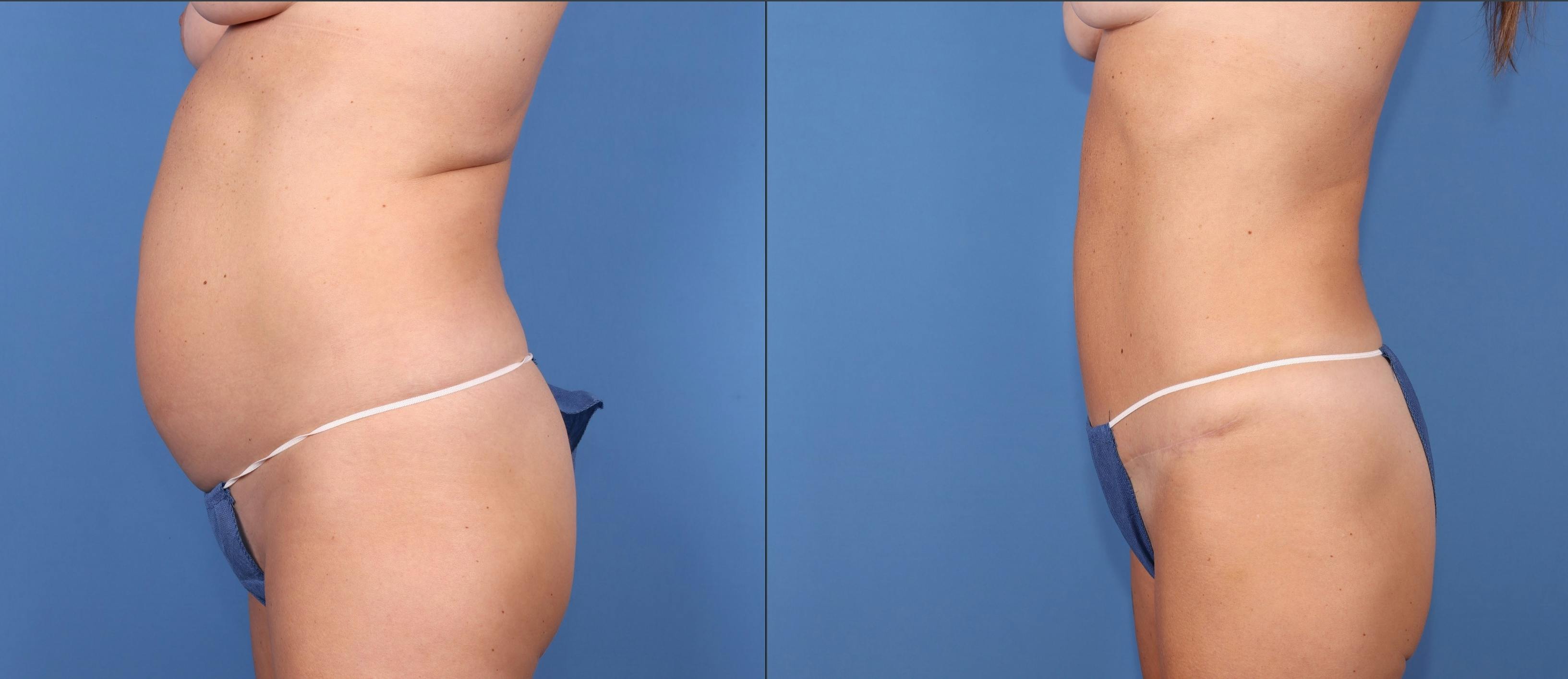 Abdomen Before & After Gallery - Patient 693186 - Image 5