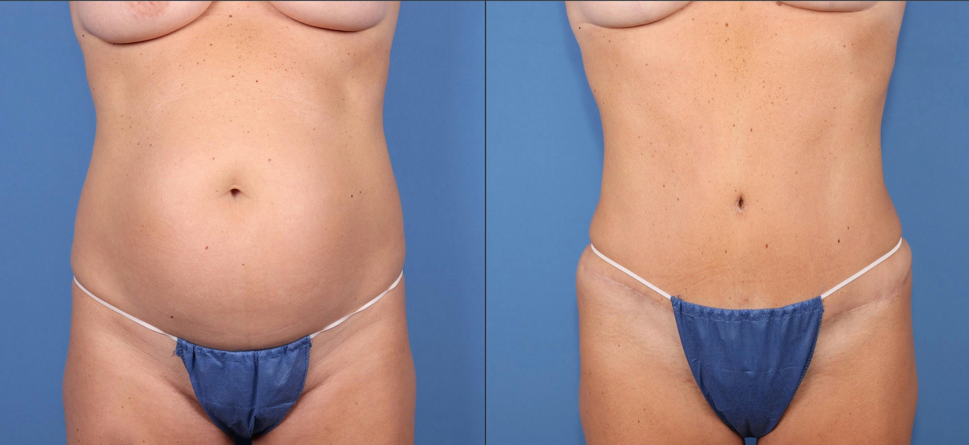 Abdomen Before & After Gallery - Patient 693186 - Image 1